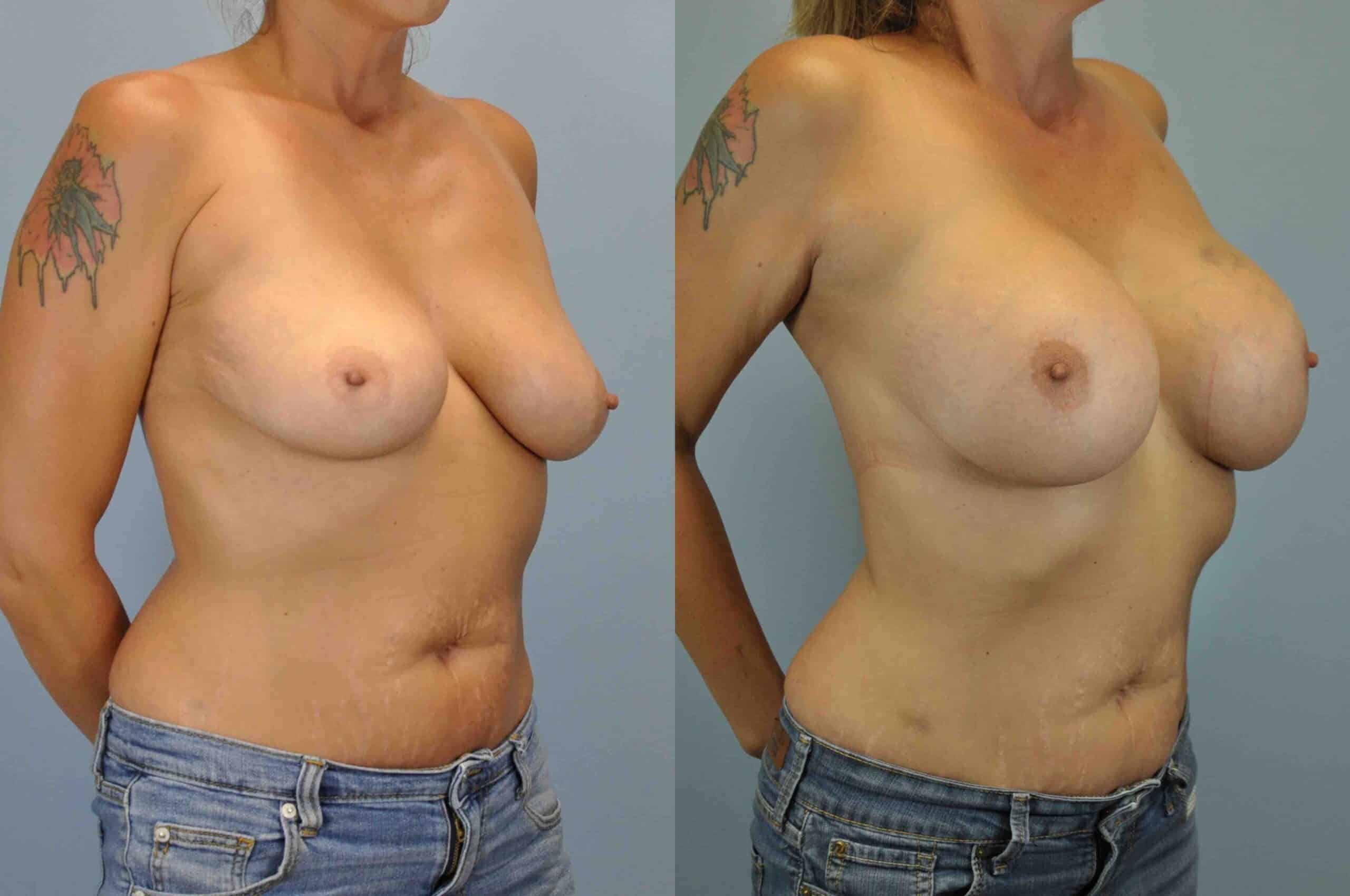Before and after, patient 2 yr post op from breast augmentation and level III muscle release procedures performed by Dr. Paul Vanek