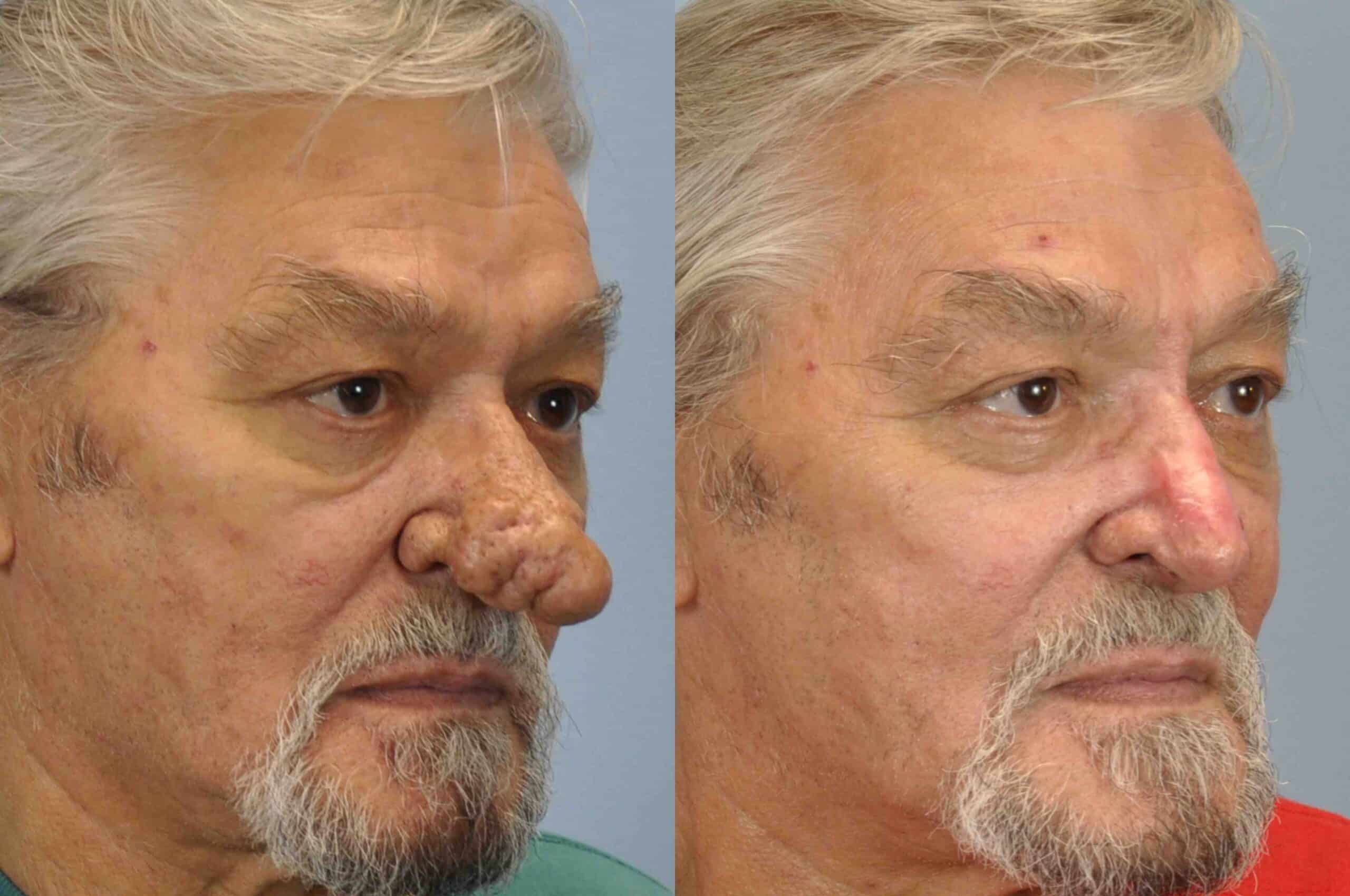 Before and after, 11 mo post op from Rhinoplasty, Rhinophyma performed by Dr. Paul Vanek