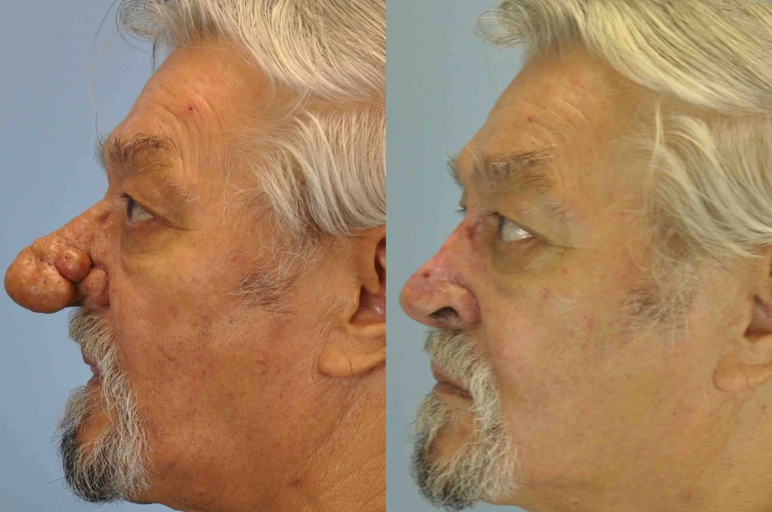 Before and after, 11 mo post op from Rhinoplasty, Rhinophyma performed by Dr. Paul Vanek
