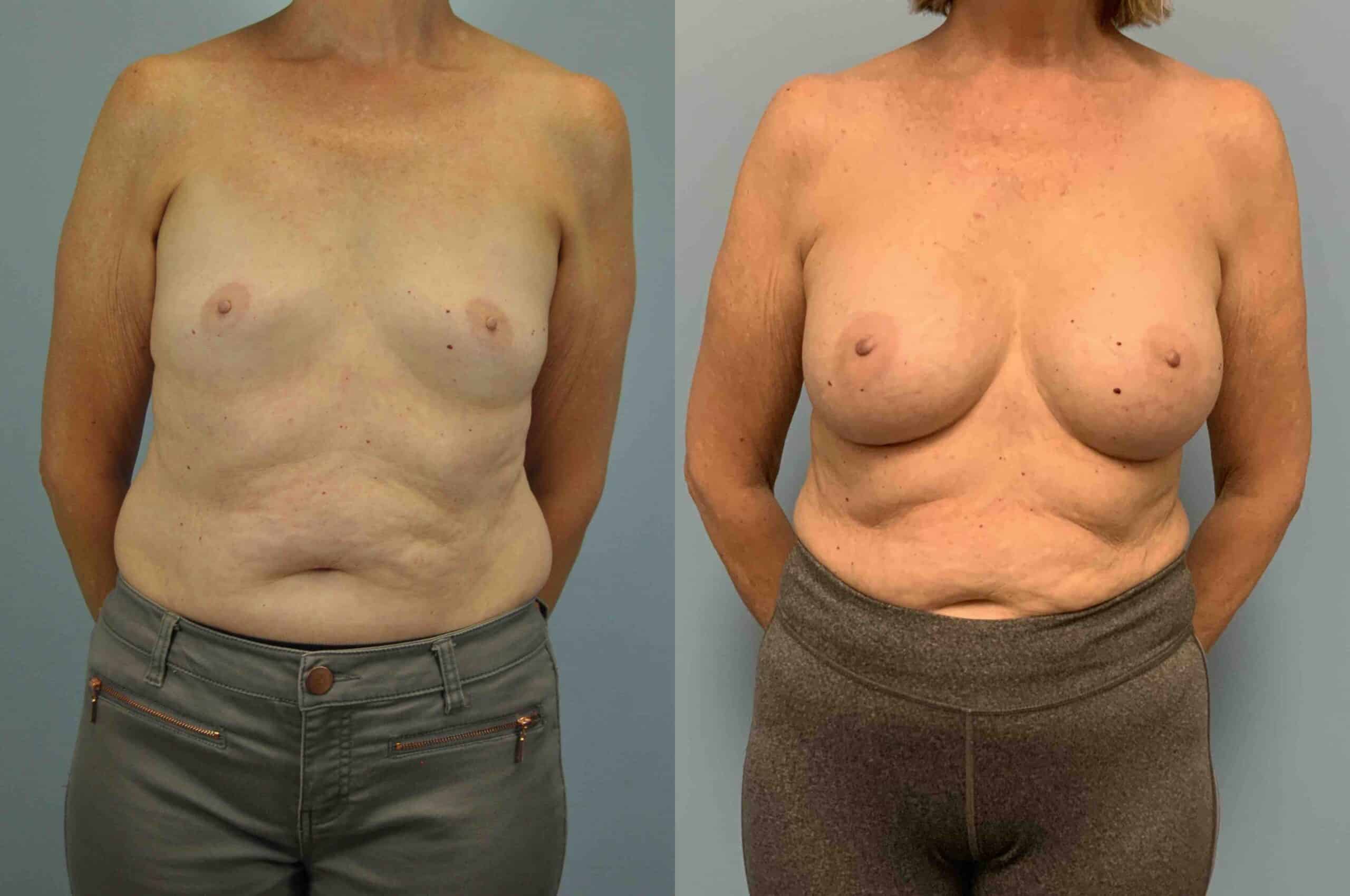 Before and after, patient 3 yr post op from Breast Augmentation and Level III Muscle Release procedures performed by Dr. Paul Vanek