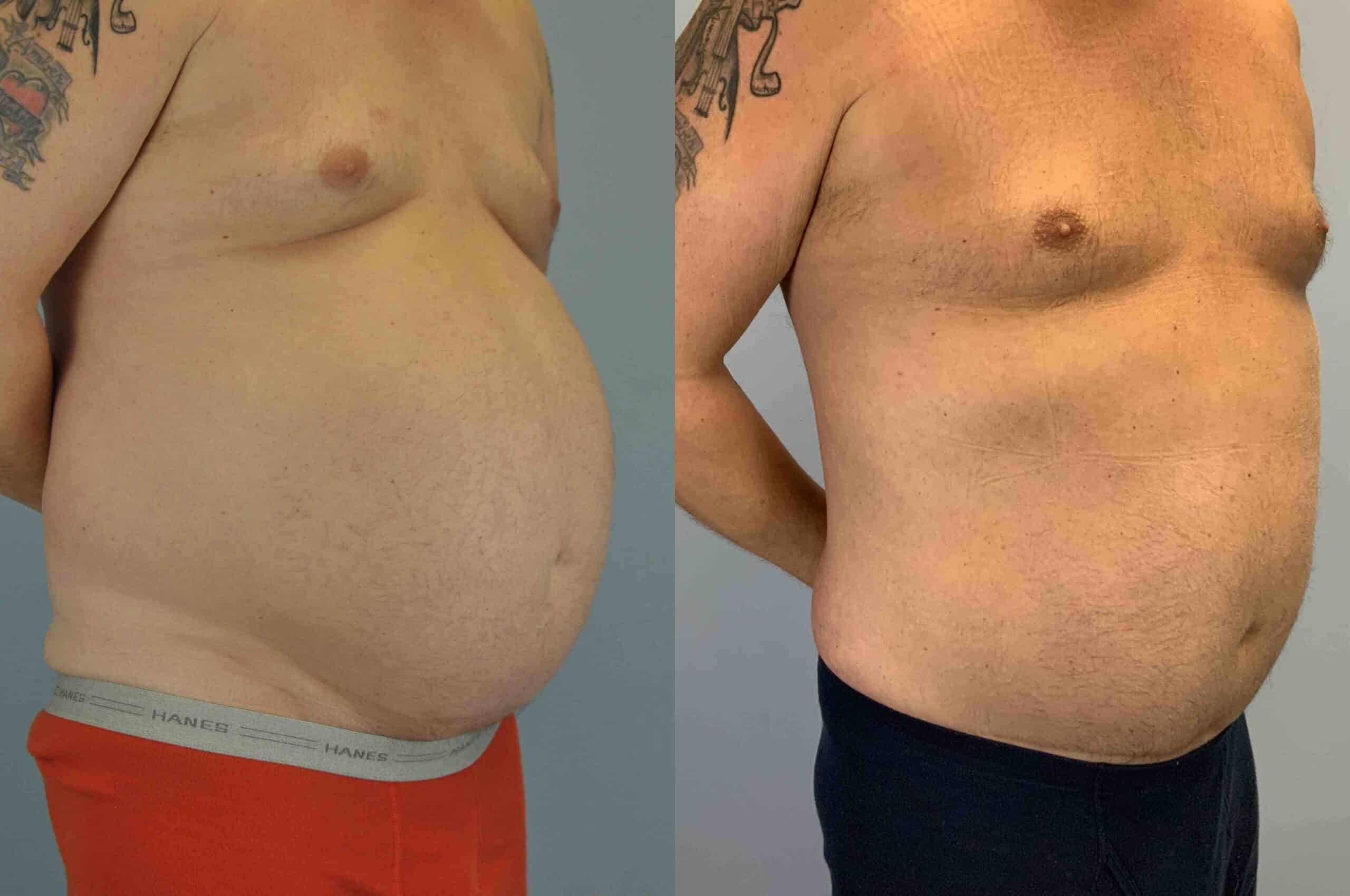 Before and after, patient 2 yrs post op from VASER Abdomen, and Flanks, Tummy Tuck procedures performed by Dr. Paul Vanek