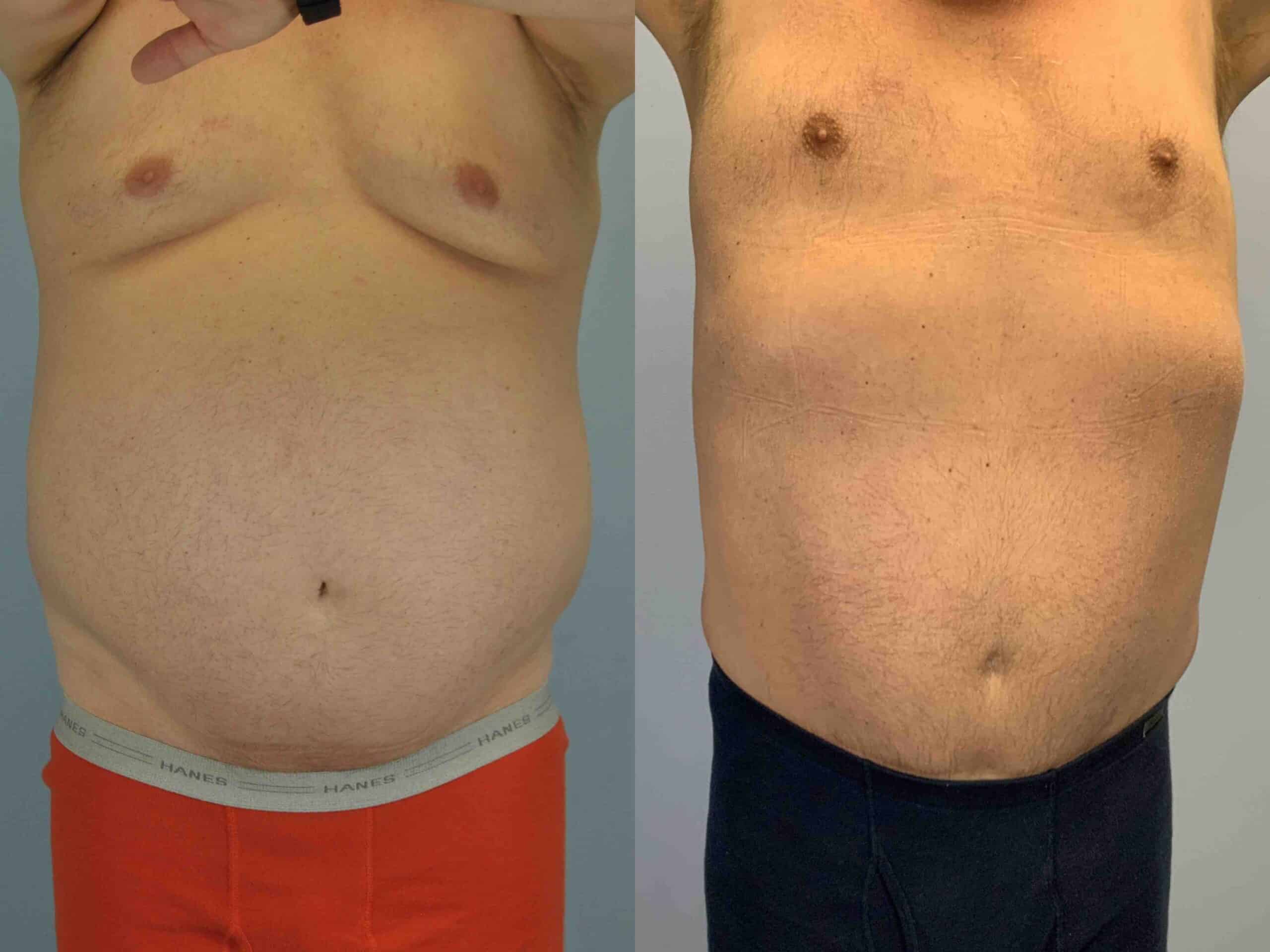 Before and after, patient 2 yrs post op from VASER Abdomen, and Flanks, Tummy Tuck procedures performed by Dr. Paul Vanek