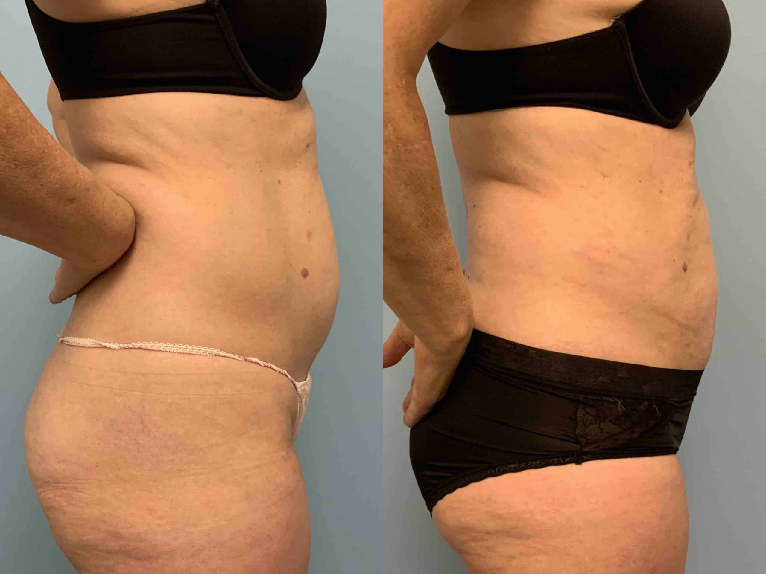 Before and after, patient 3 mo post op from VASER Abdomen, Renuvion Abdomen, procedure performed by Dr. Paul Vanek