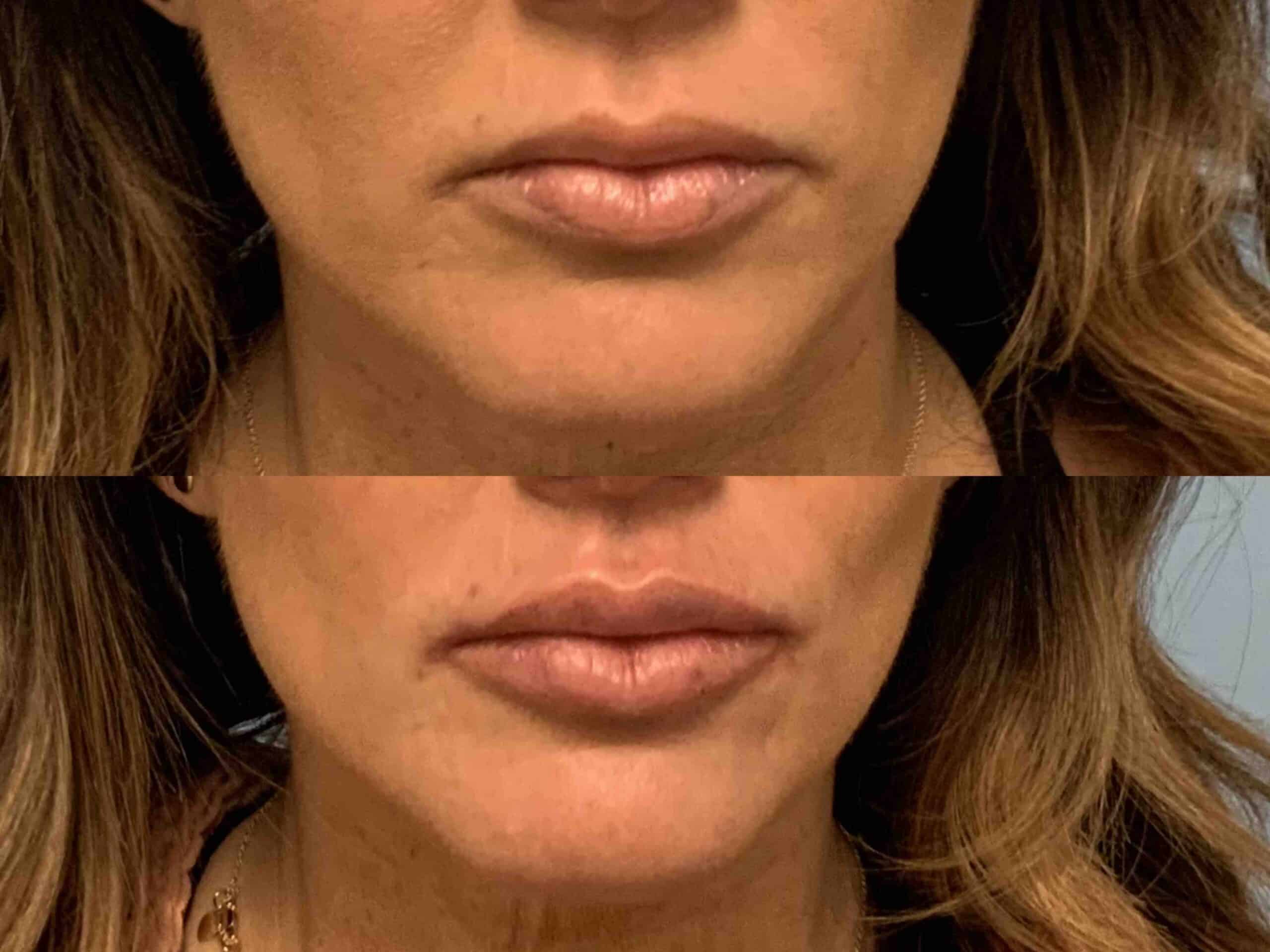Before and after, patient same day after Restylane Kysse Lip Filler procedure performed by Dr. Paul Vanek
