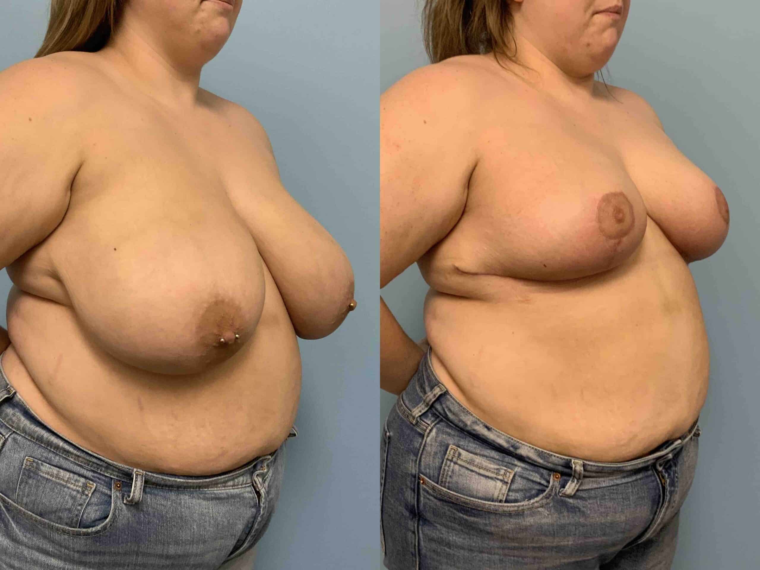 Before and after, patient 6 mo post op from Breast Reduction procedure performed by Dr. Paul Vanek