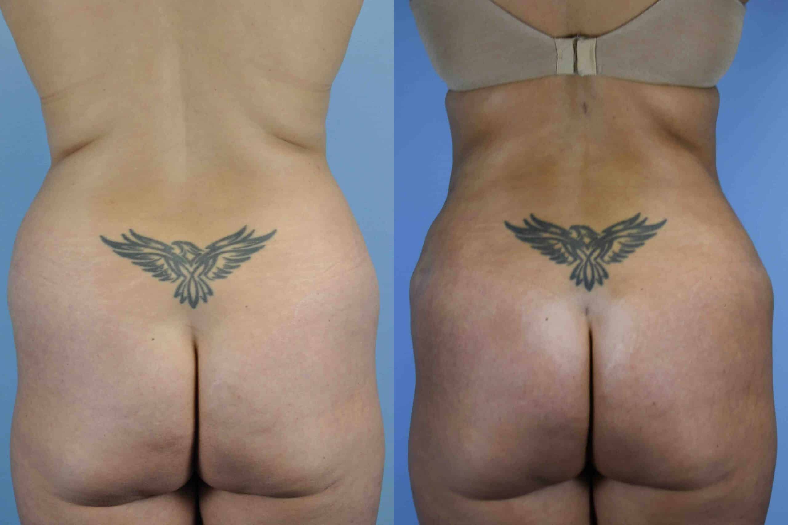 Before and after, patient 6 mo post op from Renuvion Abdomen and Flanks, VASER Abdomen and Flanks,Tummy Tuck with Hernia Repair procedures performed by Dr. Paul Vanek