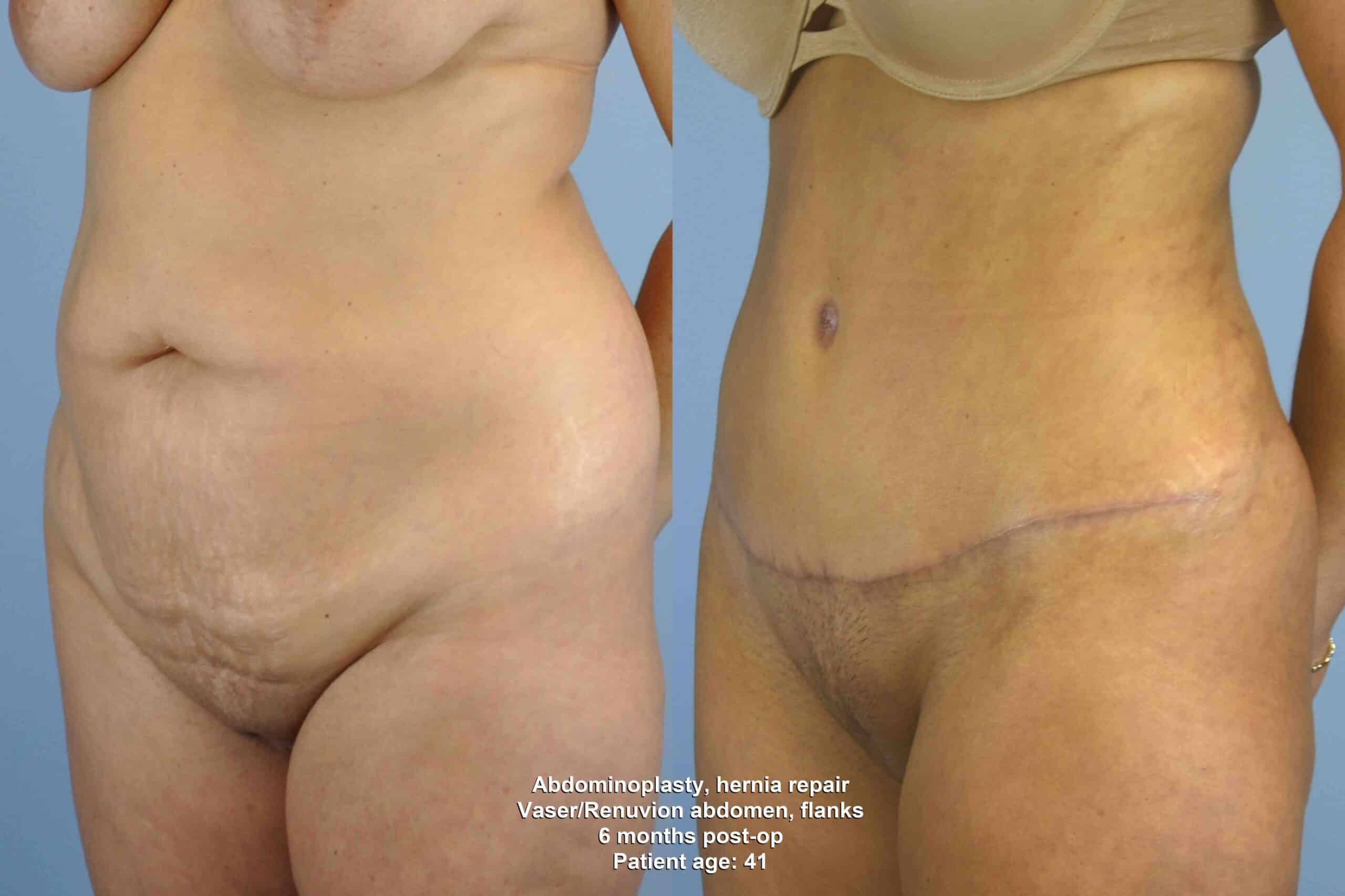 Before and after, patient 6 mo post op from Renuvion Abdomen and Flanks, VASER Abdomen and Flanks,Tummy Tuck with Hernia Repair procedures performed by Dr. Paul Vanek