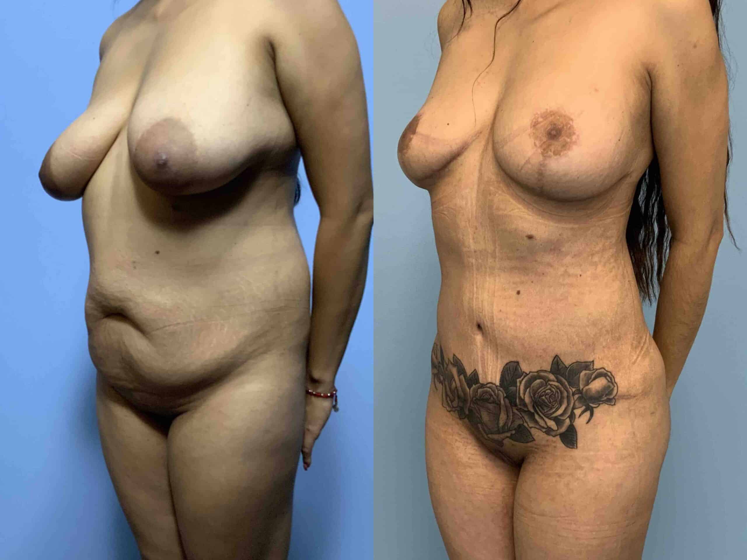 Before and after, patient 1 yr post op from VASER Abdomen, Flanks, Back Axilla, Brazilian Butt Lift, Mastopexy/Breast Lift, Panniculectomy (lower tummy tuck), and Renuvion Abdomen, Flanks, Back Axilla procedures performed by Dr. Paul Vanek