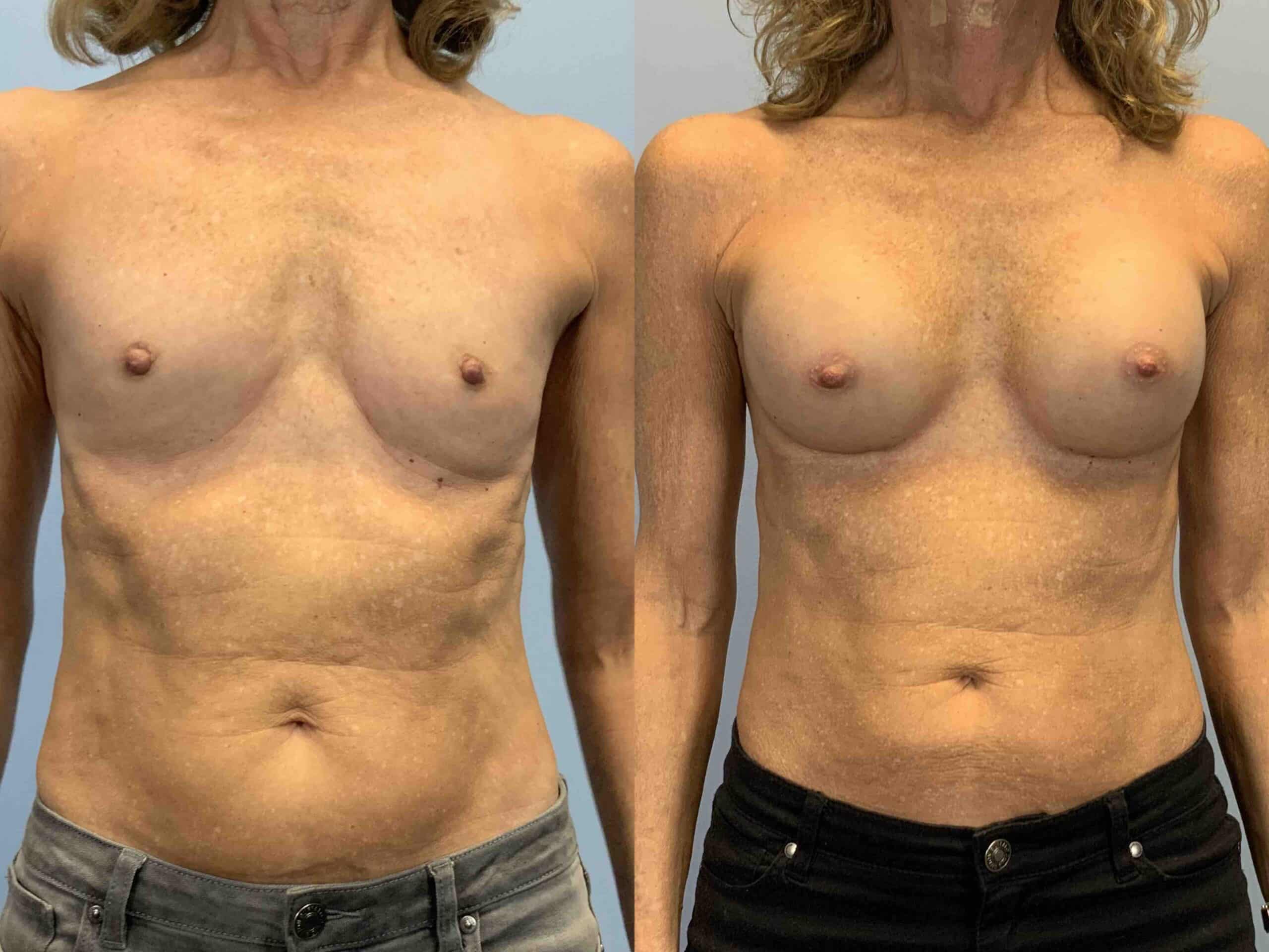 Before and after, patient 4 mo post op from Breast Augmentation procedure performed by Dr. Paul Vanek