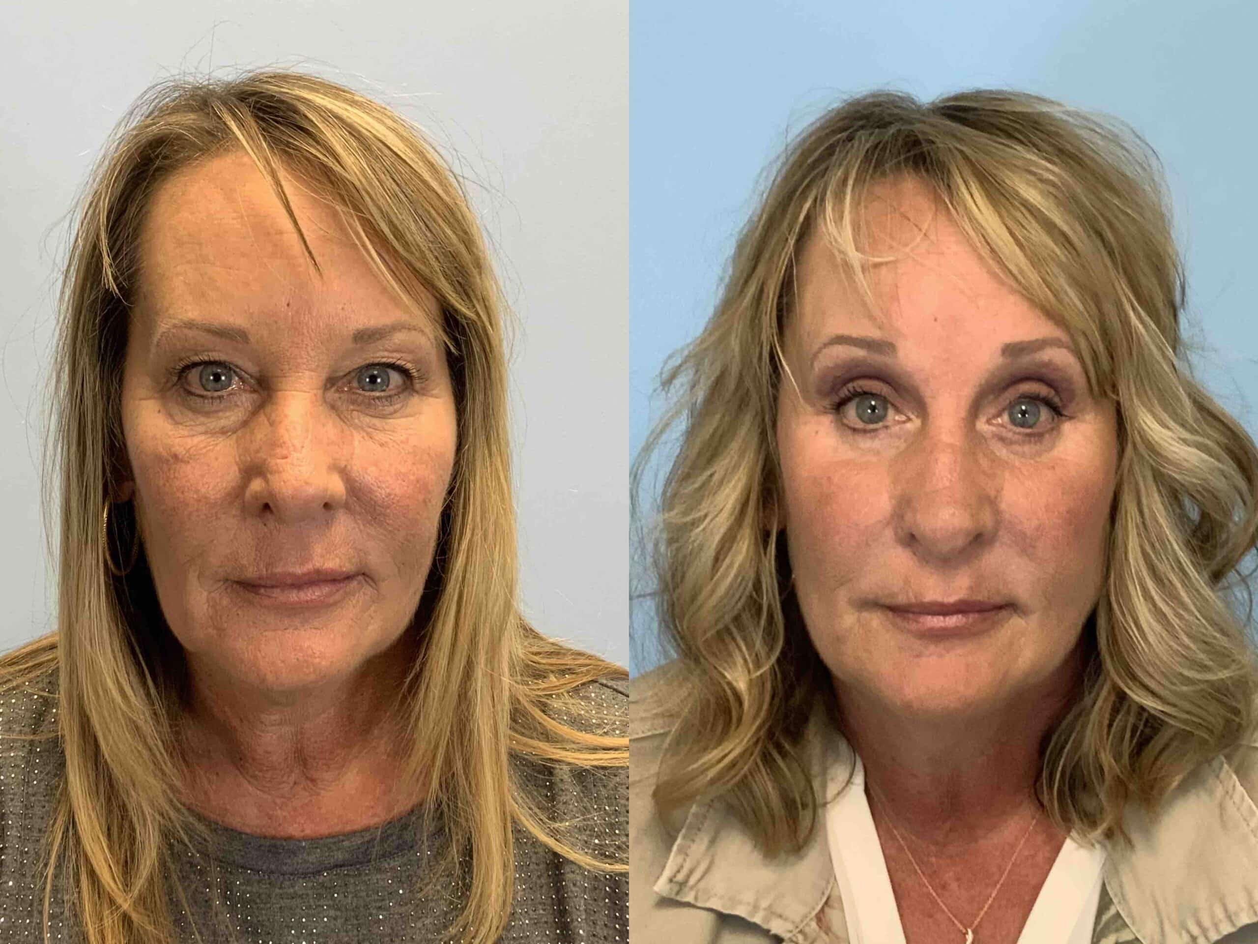 Before and after, 7 mo post op from Rhinoplasty, Septoplasty, Upper and Lower Blepharoplasty, Canthopexy, Endo Brow Lift performed by Dr. Paul Vanek