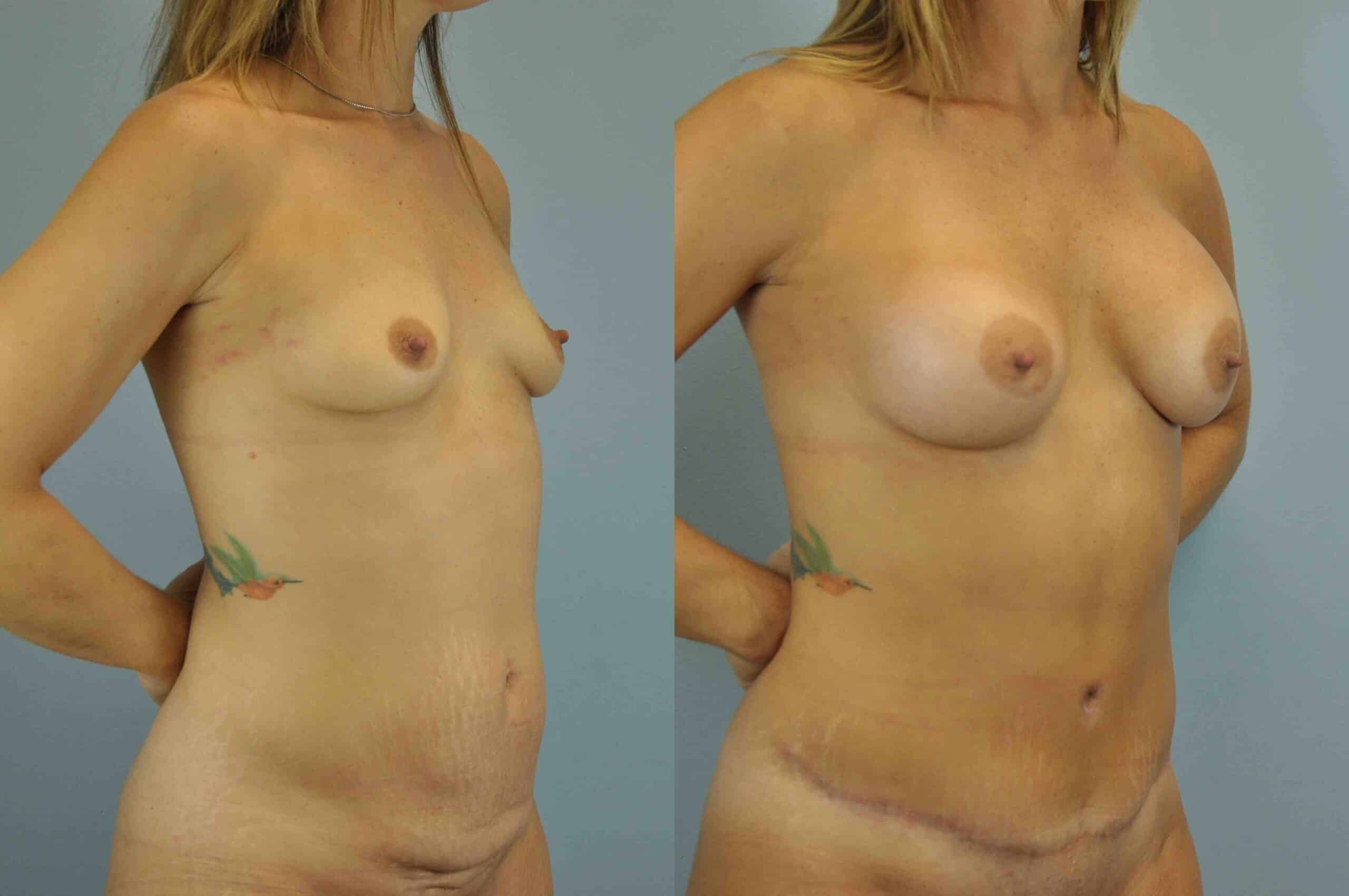 Before and after, patient 2 mo post op from Tummy Tuck and Breast Augmentation procedures performed by Dr. Paul Vanek