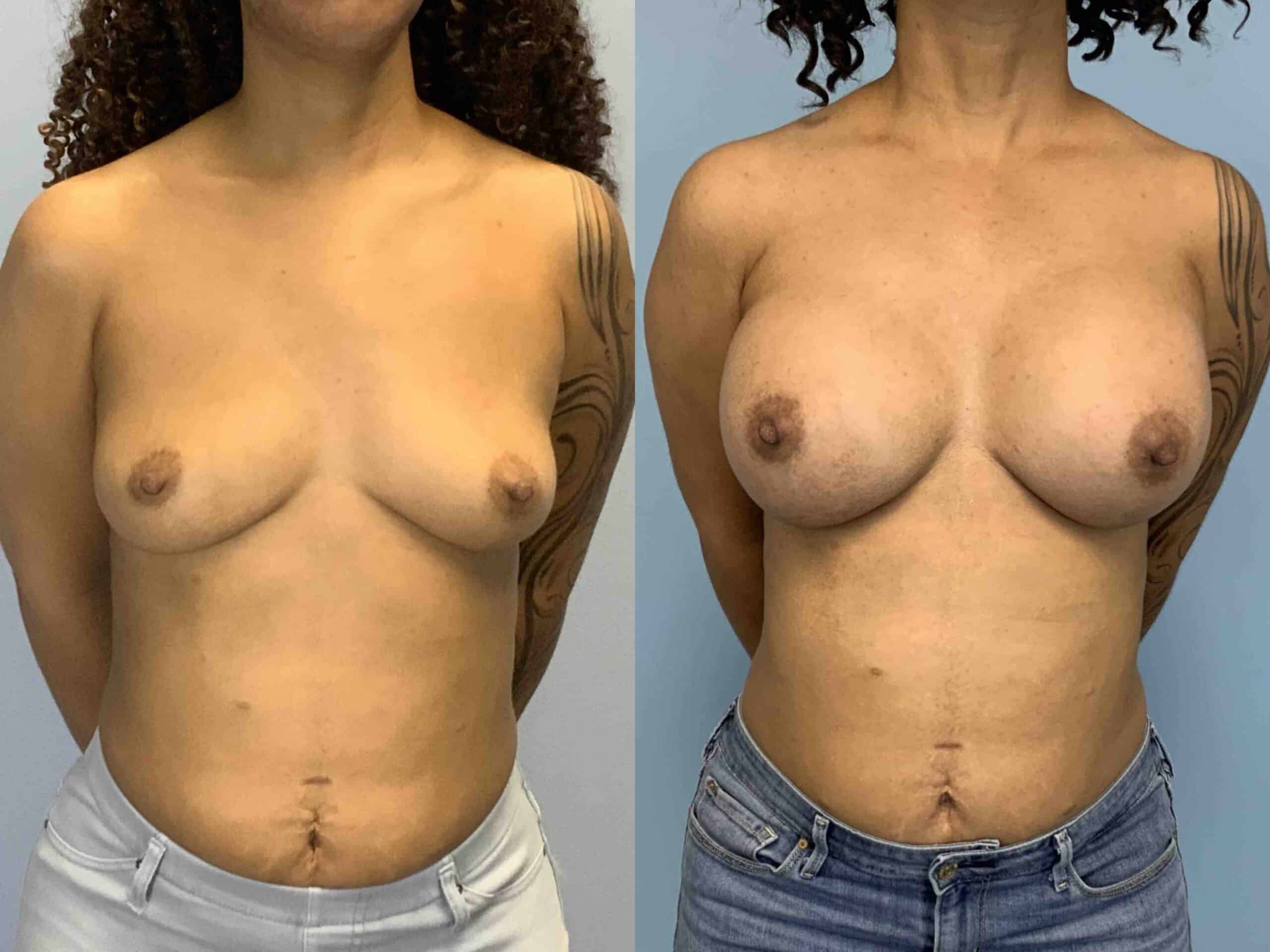 Before and after, patient 2 mo post op from Breast Augmentation and Level III Muscle Release procedures performed by Dr. Paul Vanek