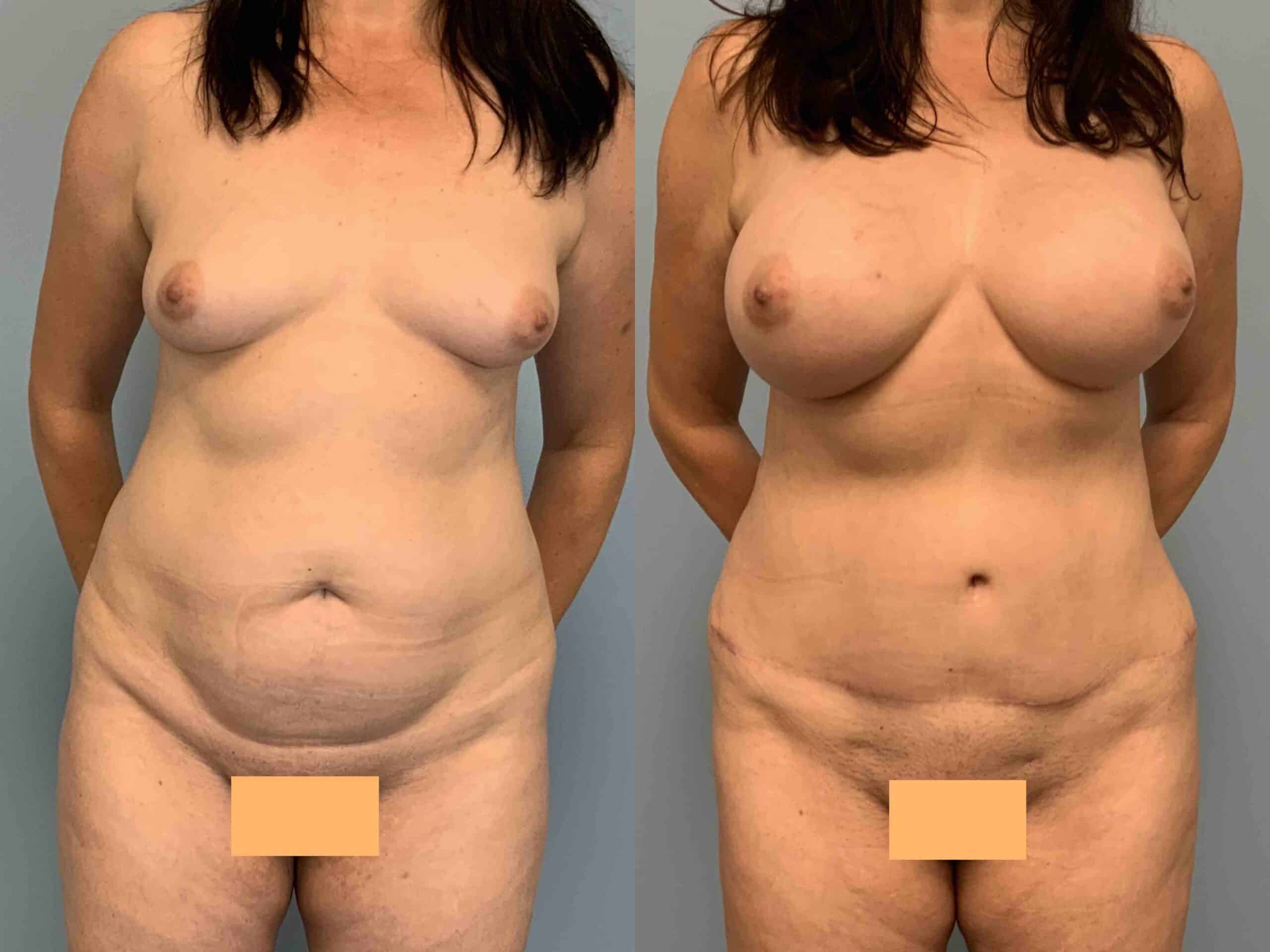 Before and after, patient 1 yr post op from VASER Renuvion Abdomen, Tummy Tuck, Flanks, Mons Thighs, Brazilian Butt Lift, Breast Augmentation, Level III Muscle Release procedures performed by Dr. Paul Vanek