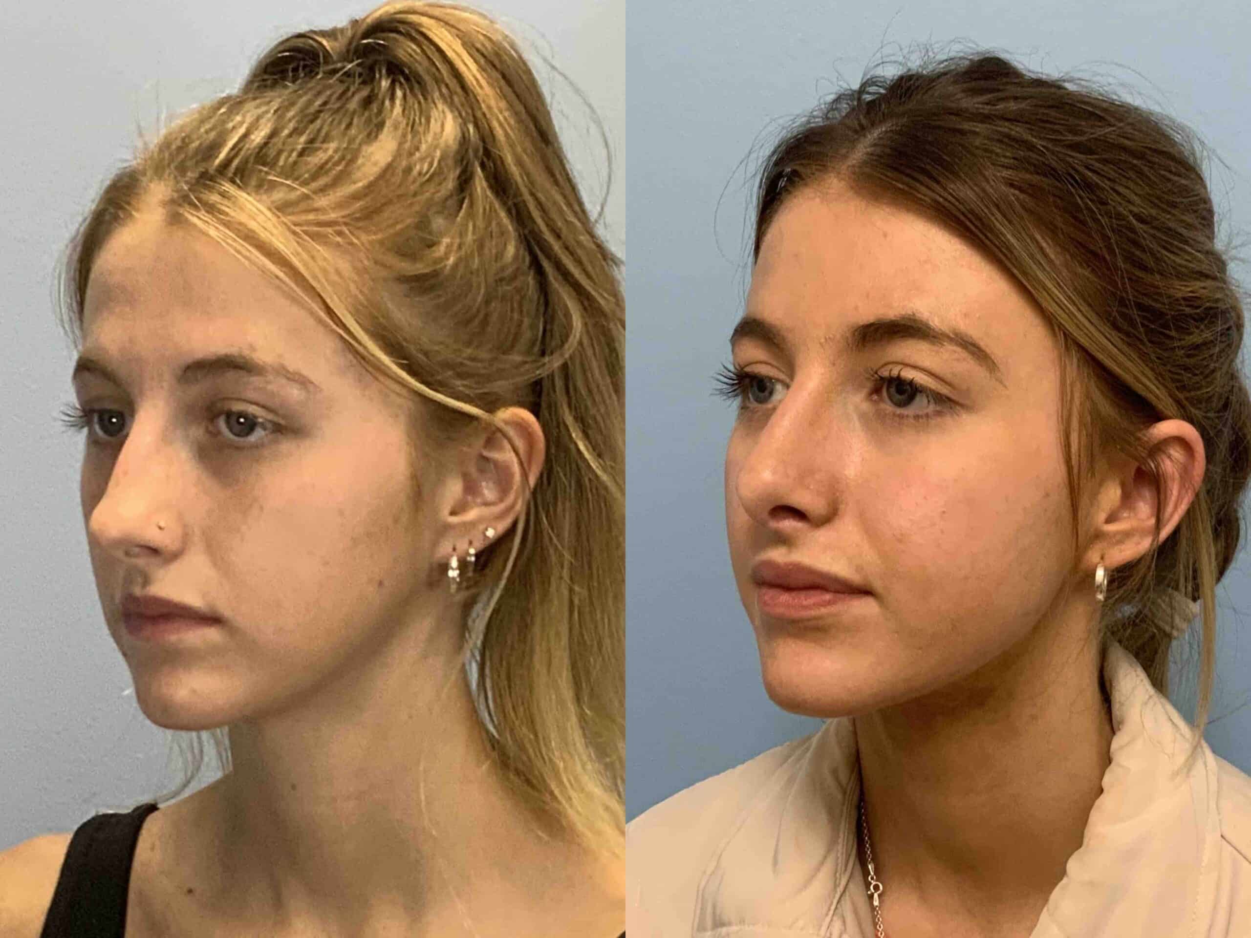Before and after, 4 mo post op from Rhinoplasty and Septoplasty performed by Dr. Paul Vanek