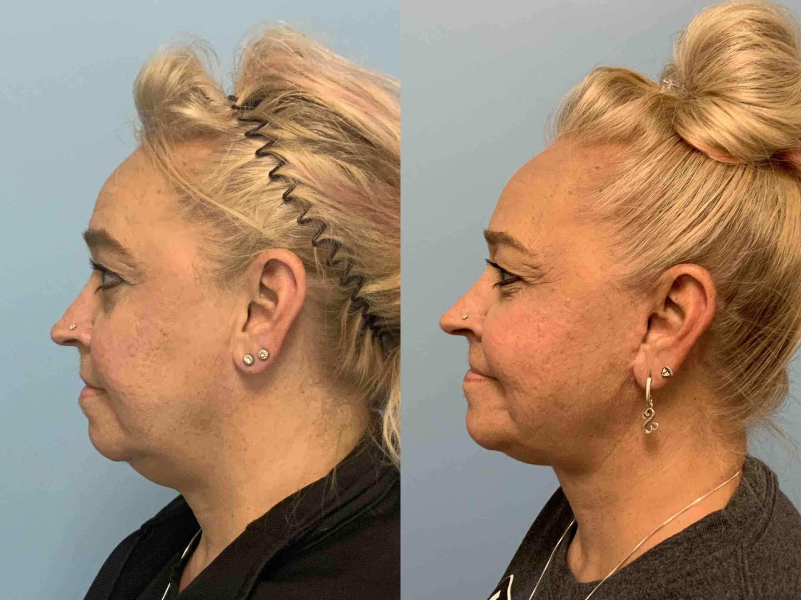 Before and after, patient 1 yr post op from Neck Lift, VASER and Renuvion Neck procedures performed by Dr. Paul Vanek