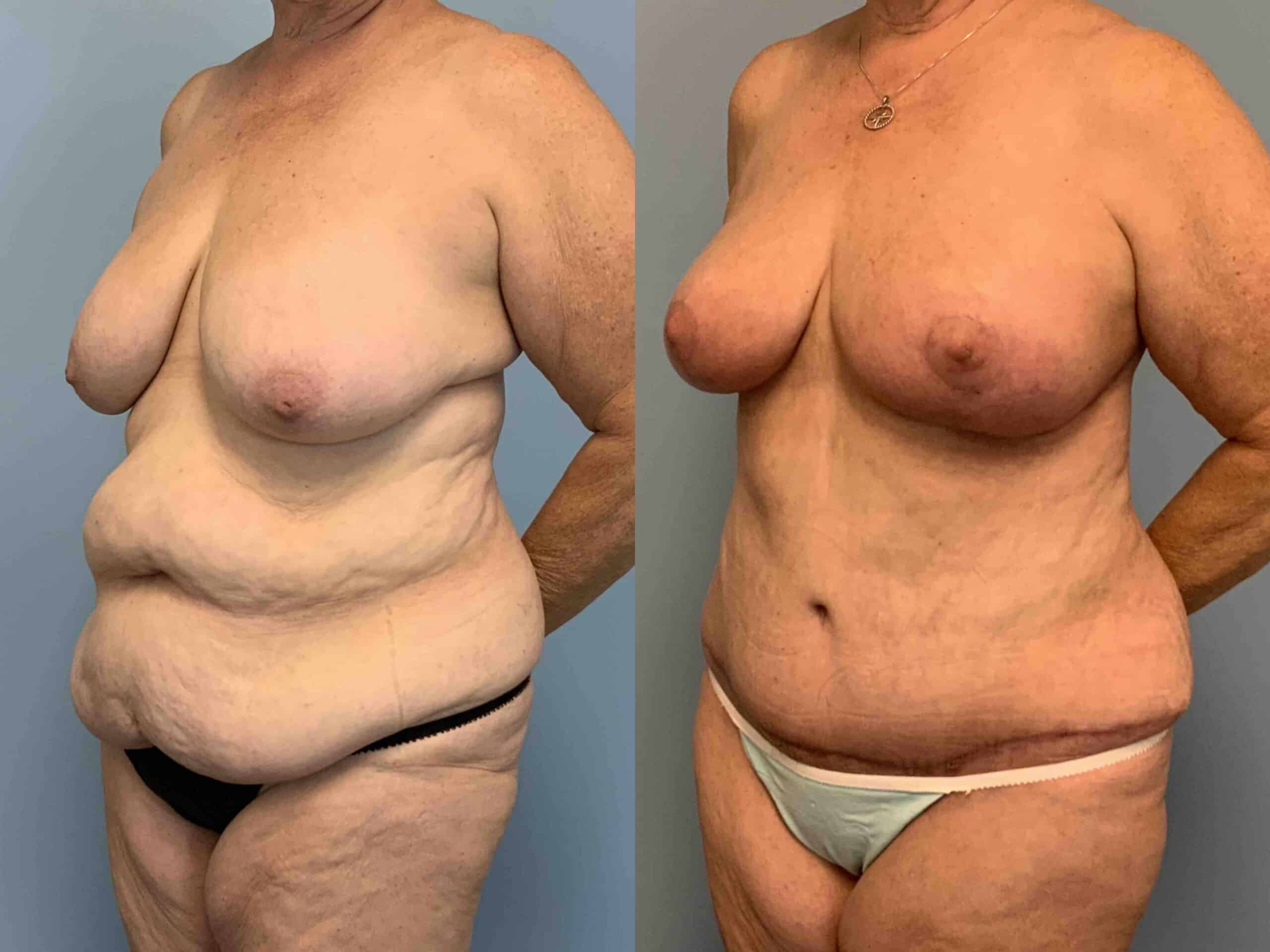 Before and after, patient 2 mo post op from Breast Reduction, Tummy Tuck, VASER Abdomen, Renuvion Abdomen, Axilla & Mons, Axillary Roll Resection procedures performed by Dr. Paul Vanek