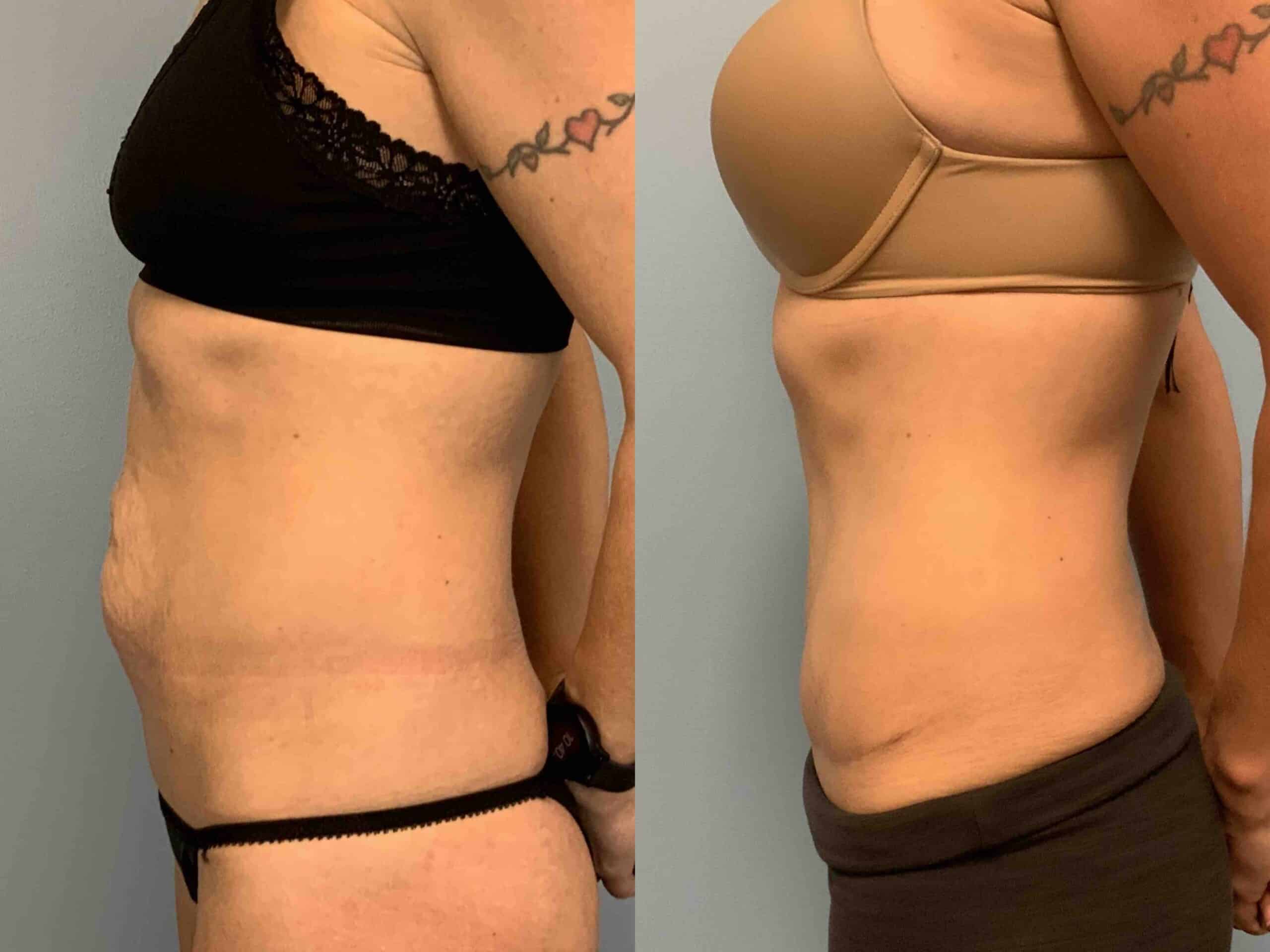 Before and after, patient 5 mo post op from Renuvion Abdomen and Flanks, VASER Abdomen and Flanks,Tummy Tuck with Umbilical Hernia Repair procedures performed by Dr. Paul Vanek