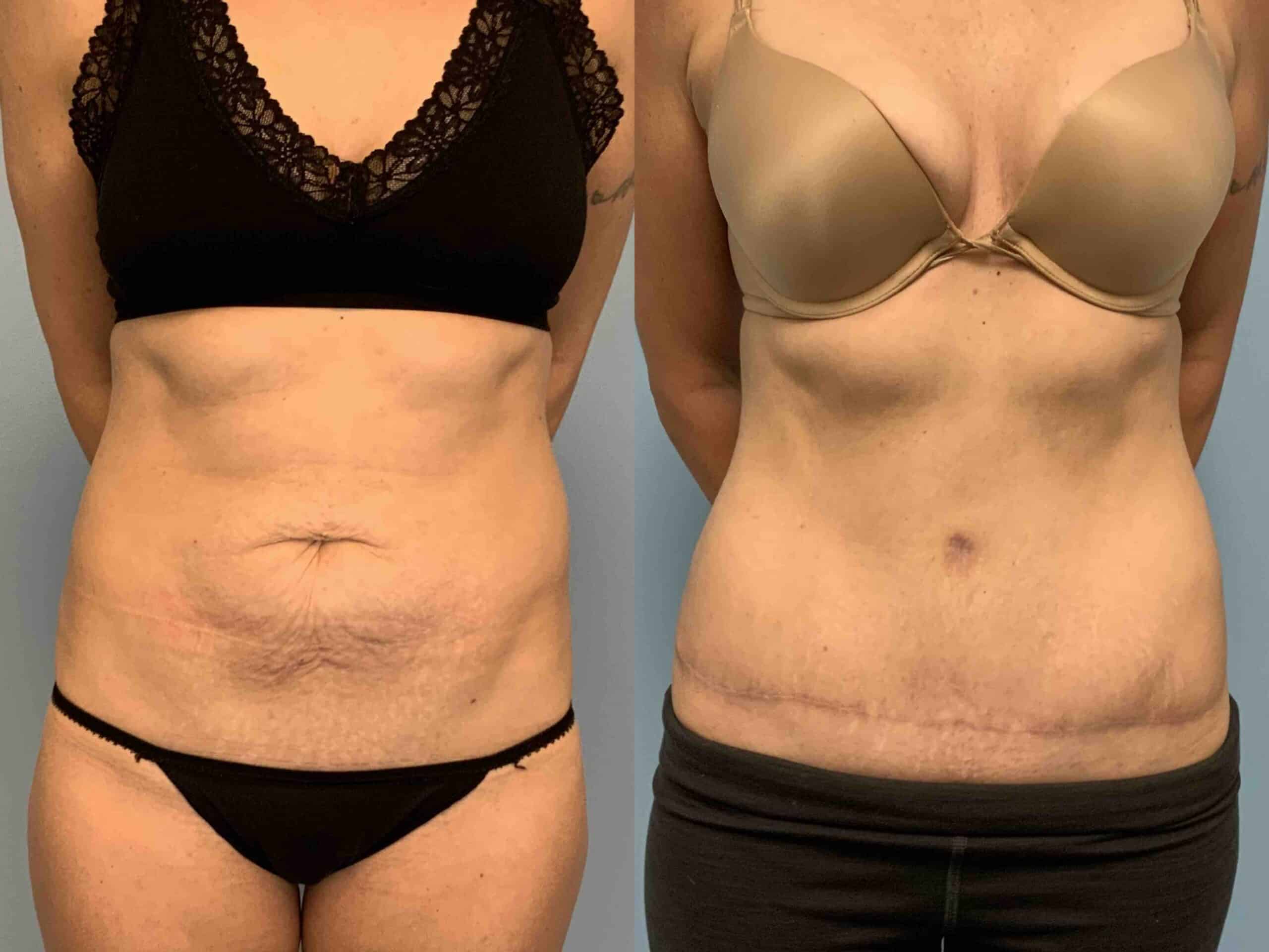 Before and after, patient 5 mo post op from Renuvion Abdomen and Flanks, VASER Abdomen and Flanks,Tummy Tuck with Umbilical Hernia Repair procedures performed by Dr. Paul Vanek