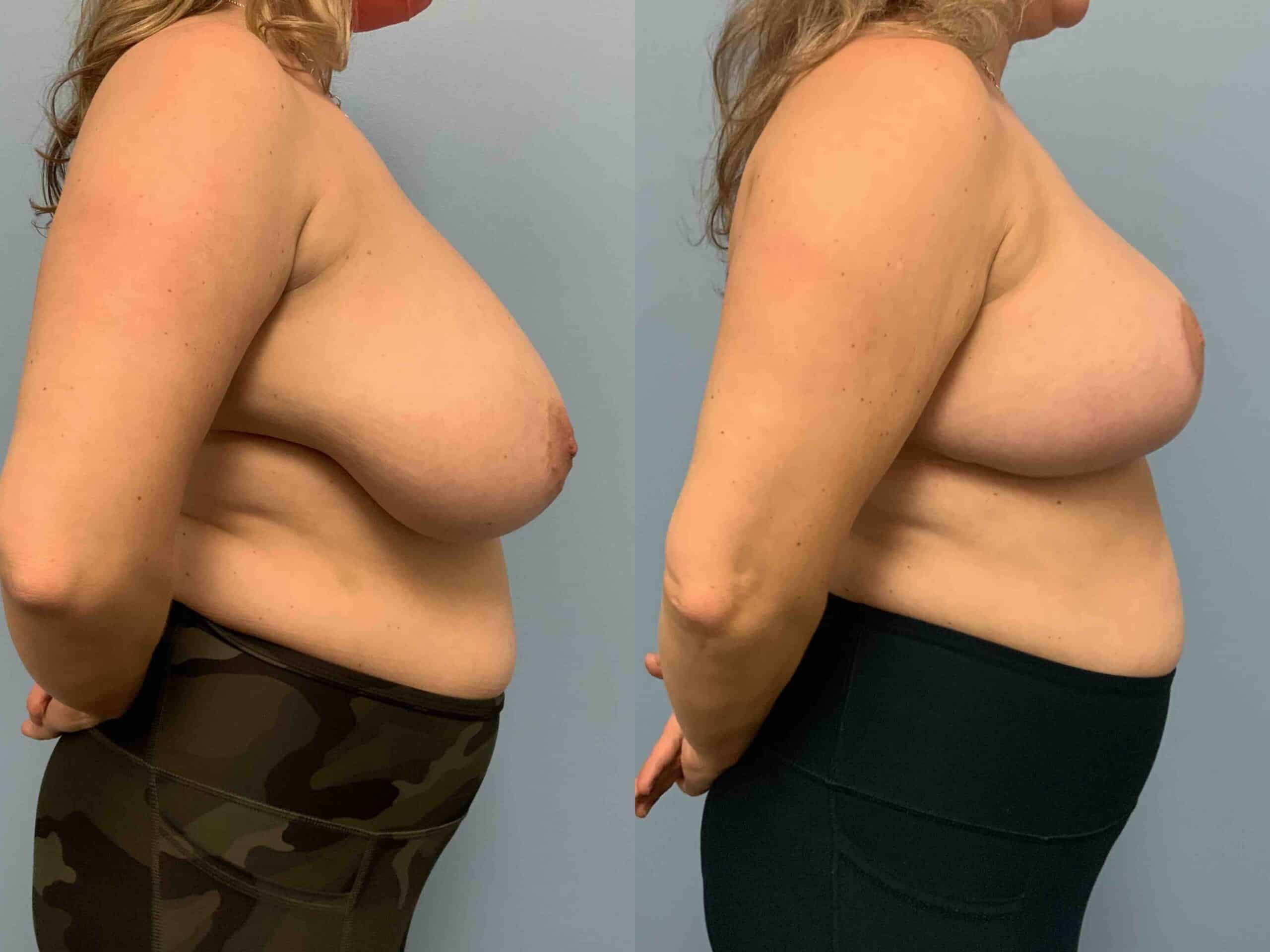 Before and after, patient 5 mo post op from Breast Reduction, Axillary Roll Resection, VASER Axilla procedures performed by Dr. Paul Vanek