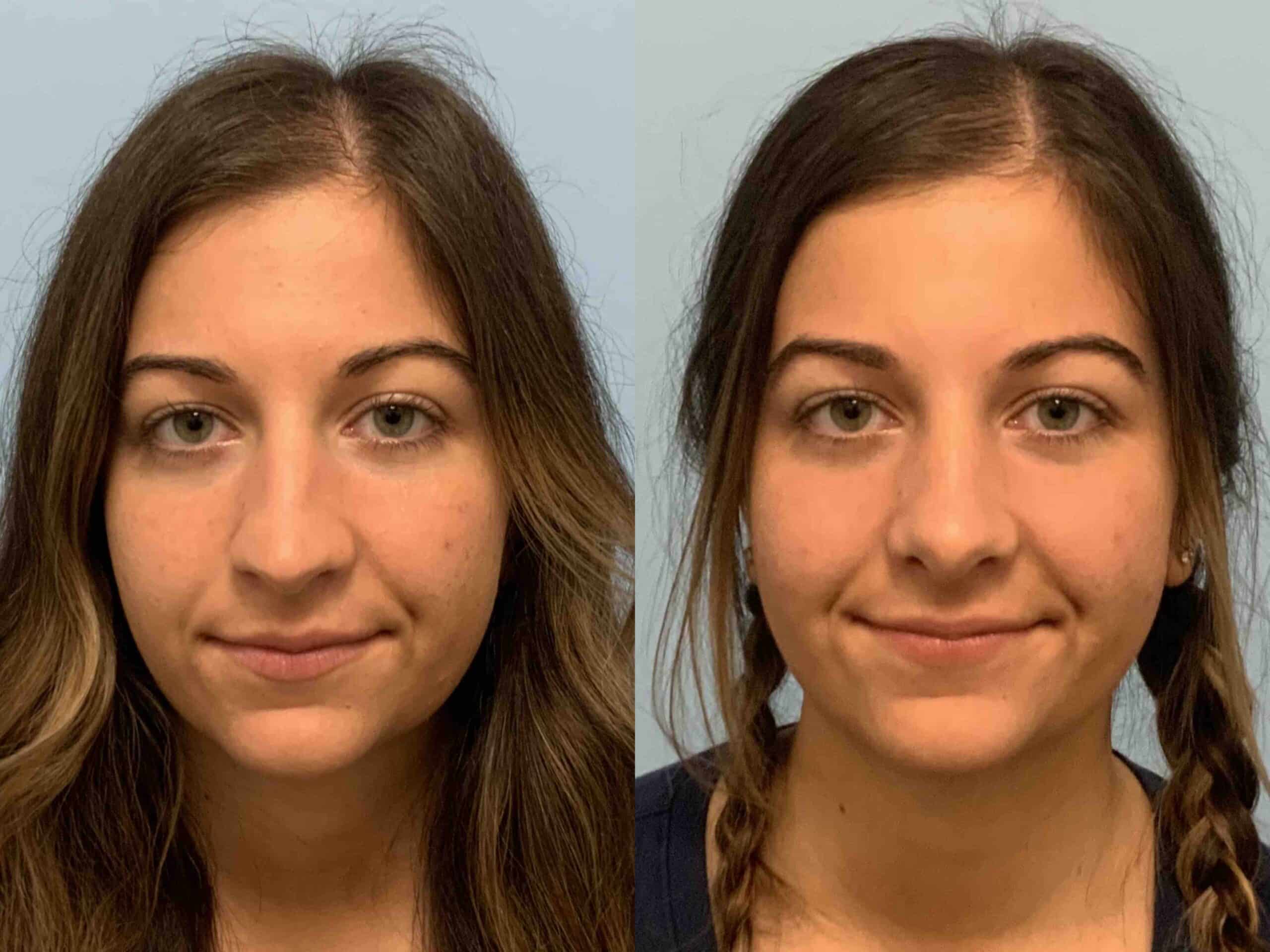 Before and after, 1 mo post op from Rhinoplasty performed by Dr. Paul Vanek