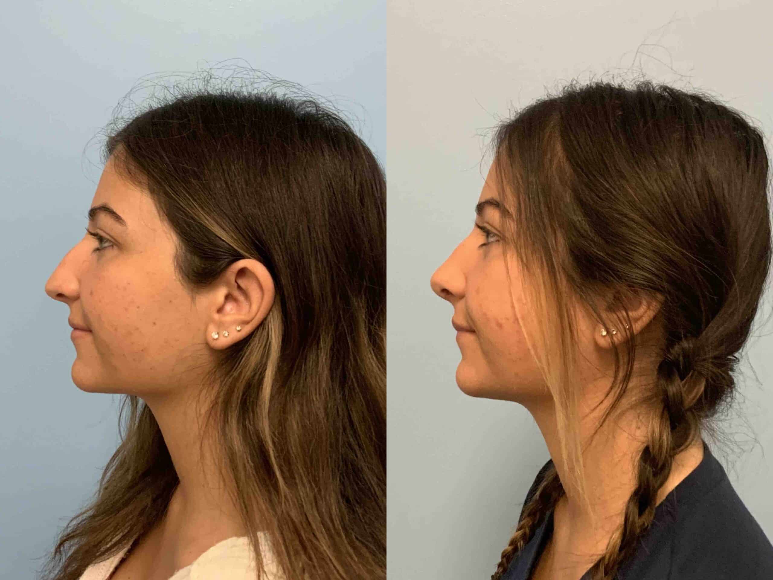 Before and after, 1 mo post op from Rhinoplasty performed by Dr. Paul Vanek