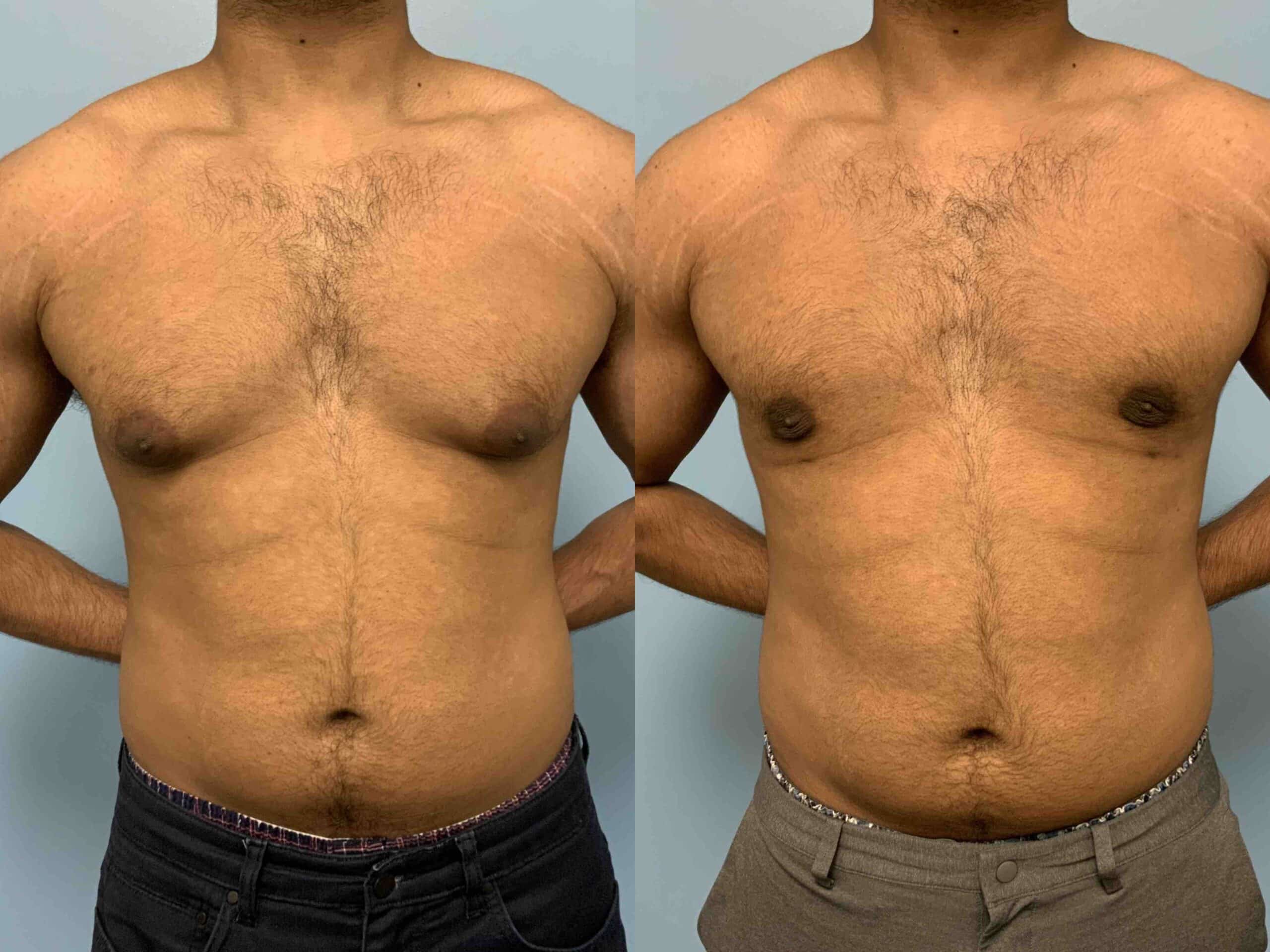 Before and after, patient 3 mo post op from Renuvion Chest, VASER Chest, Gynecomastia procedure performed by Dr. Paul Vanek