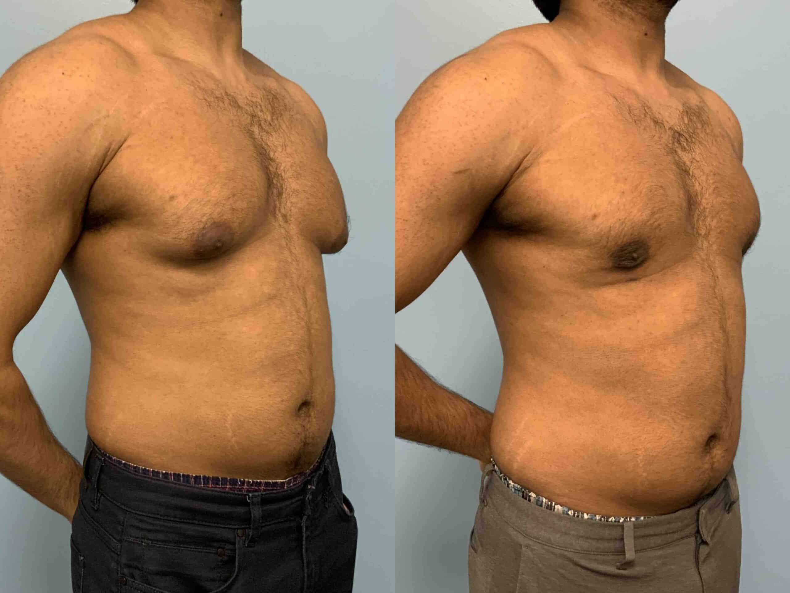 Before and after, patient 3 mo post op from Renuvion Chest, VASER Chest, Gynecomastia procedure performed by Dr. Paul Vanek