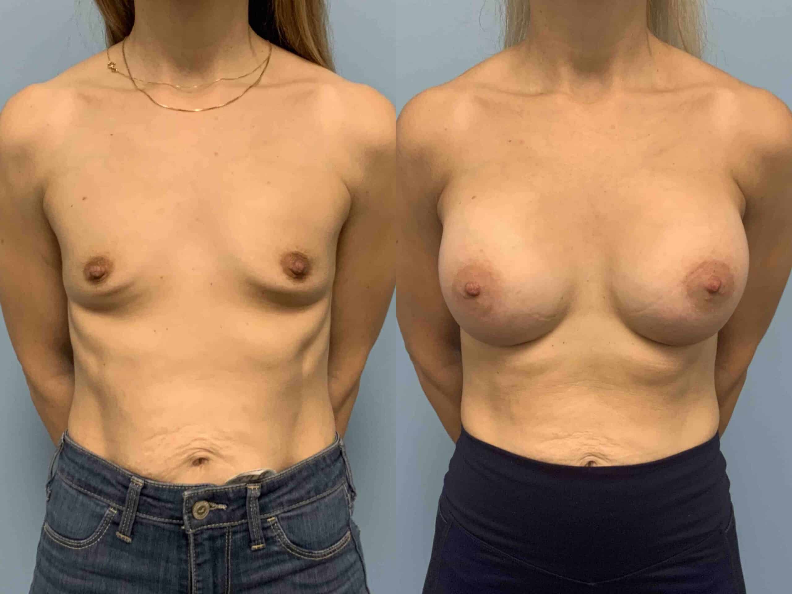 Before and after, patient 2 mo post op from Breast Augmentation, Level III Muscle Release procedures performed by Dr. Paul Vanek