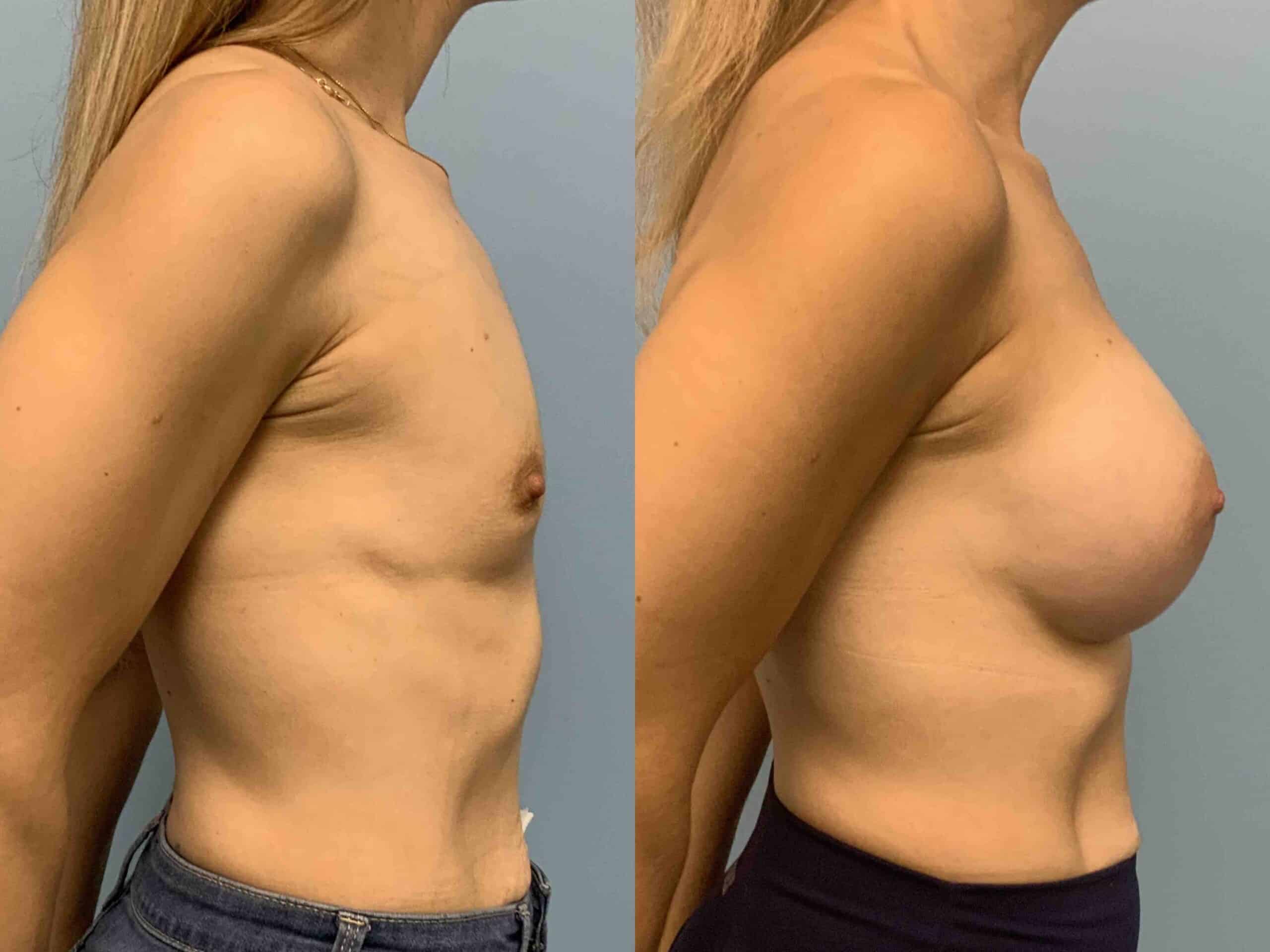 Before and after, patient 2 mo post op from Breast Augmentation, Level III Muscle Release procedures performed by Dr. Paul Vanek