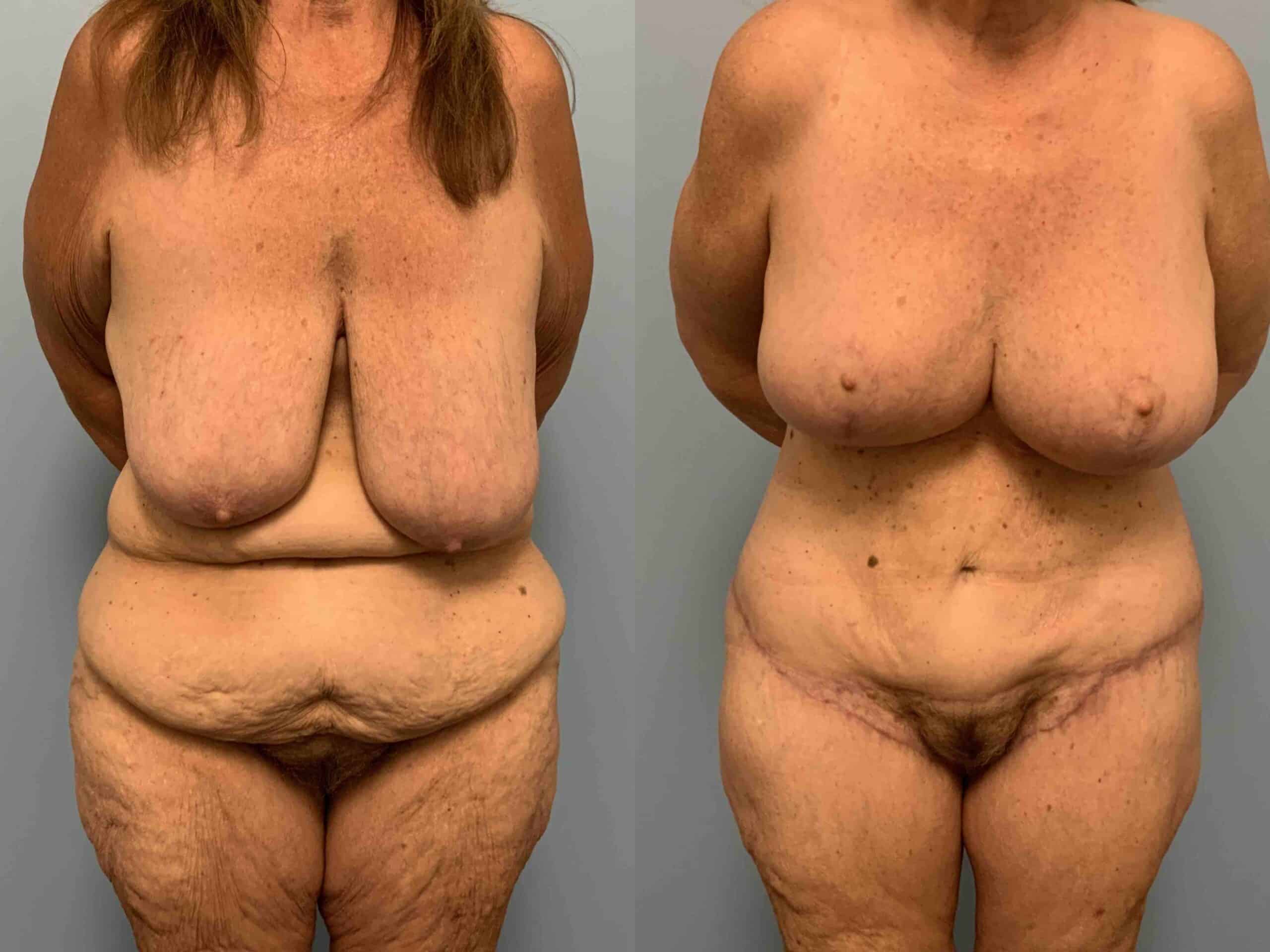 Before and after, patient 2 mo post op from VASER Abdomen, Renuvion Abdomen, Axilla & Mons, Axillary Roll Resection, Breast Reduction, Tummy Tuck procedures performed by Dr. Paul Vanek