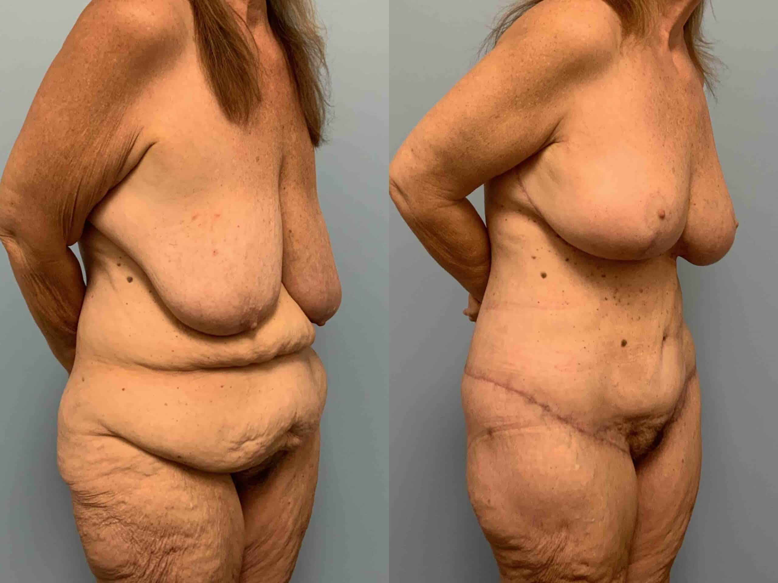 Before and after, patient 2 mo post op from VASER Abdomen, Renuvion Abdomen, Axilla & Mons, Axillary Roll Resection, Breast Reduction, Tummy Tuck procedures performed by Dr. Paul Vanek