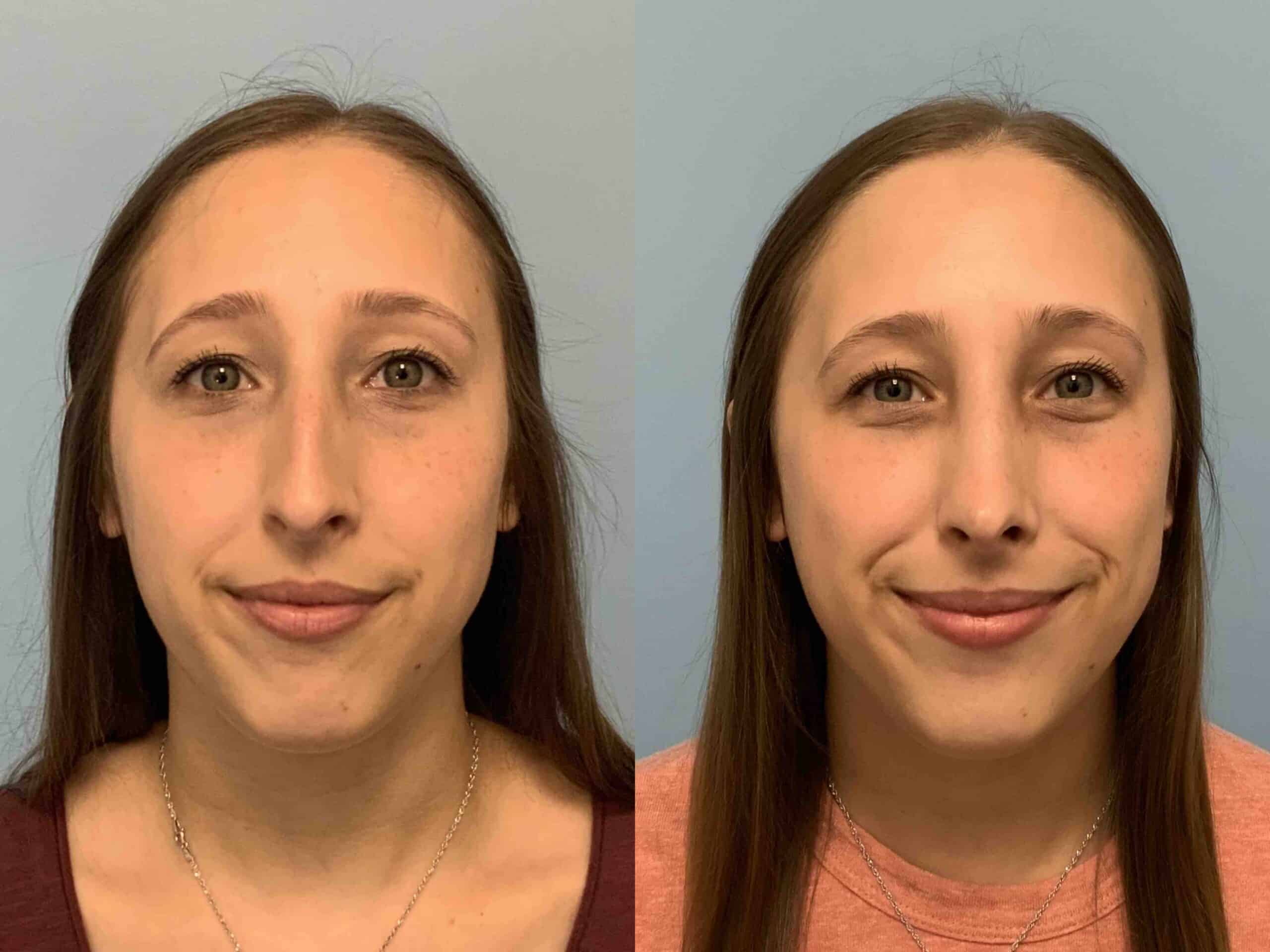 Before and after, patient 9 mo post op from Rhinoplasty and Septoplasty procedures performed by Dr. Paul Vanek