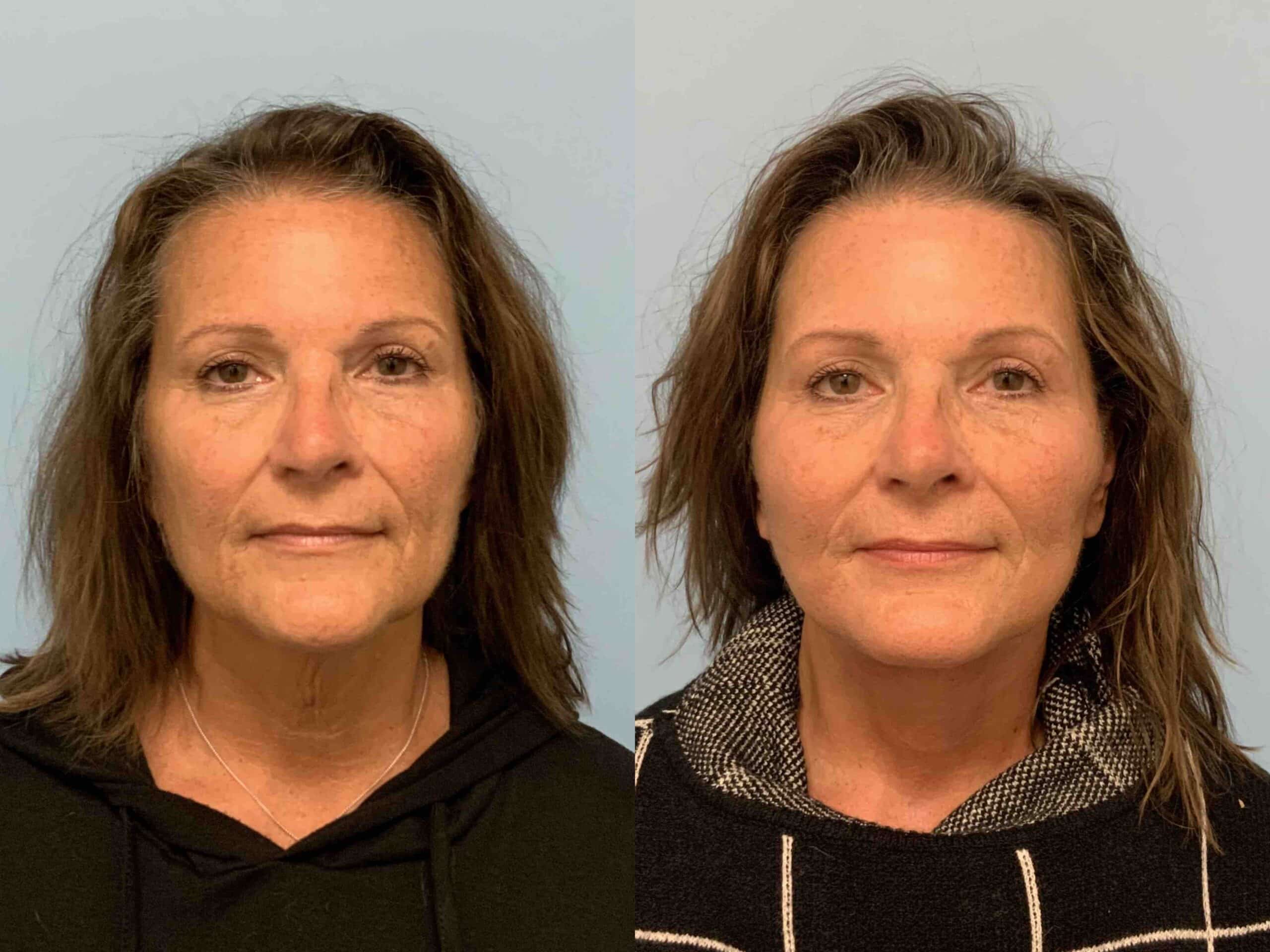 Before and after, patient 3 weeks post op from Facelift and Neck lift procedures performed by Dr. Paul Vanek