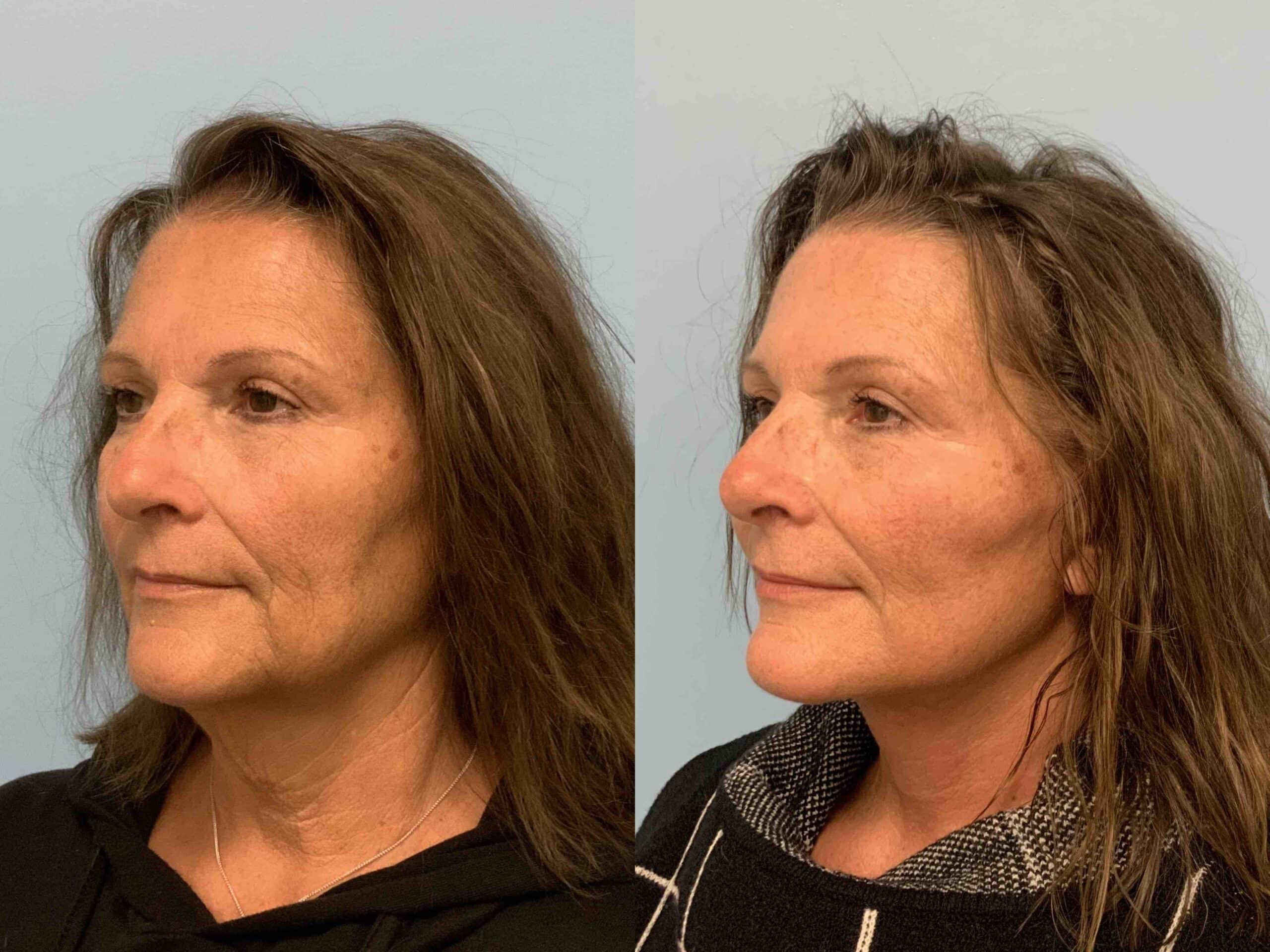 Before and after, patient 3 weeks post op from Before and after, patient 1 yr post op from Facelift and Neck lift procedures performed by Dr. Paul Vanek