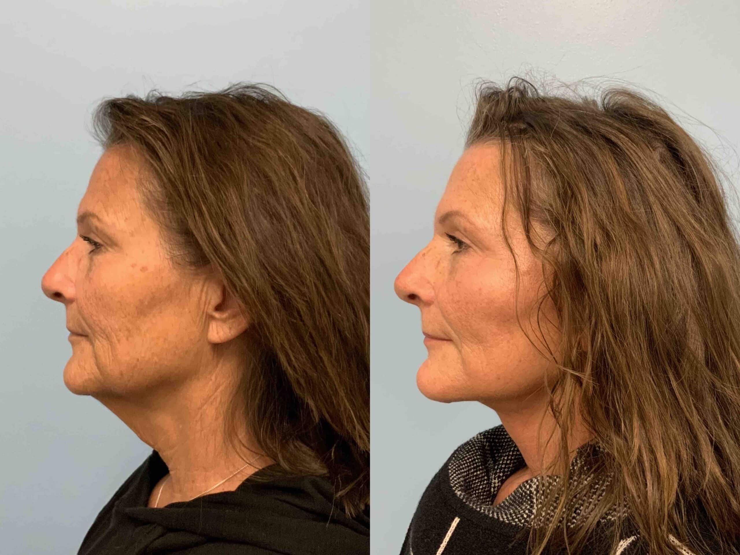 Before and after, patient 3 weeks post op from Facelift and Neck lift procedures performed by Dr. Paul Vanek