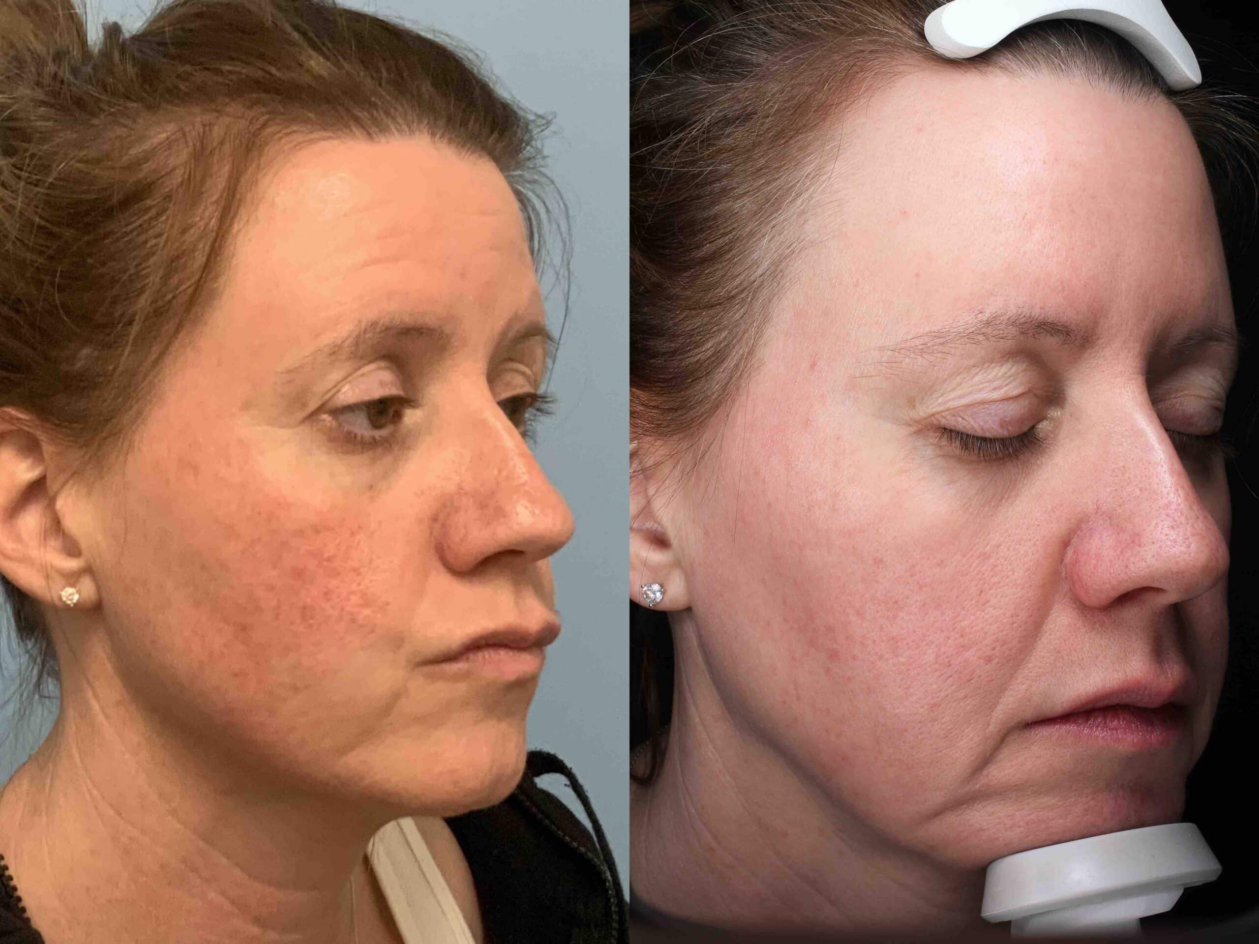 Before and after, 10 mo post-treatment from Laser Resurfacing performed by Dr. Paul Vanek