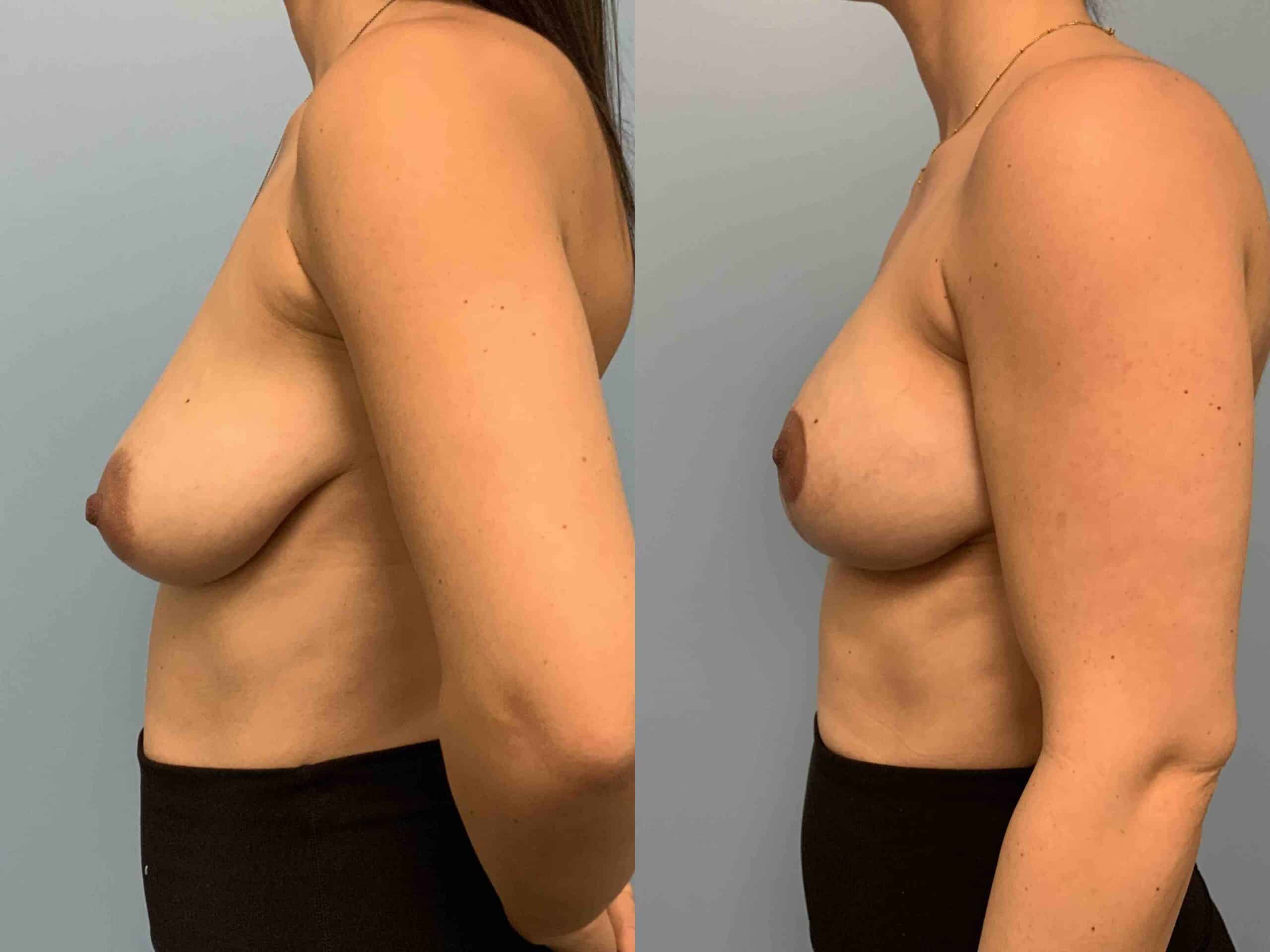 Before and after, patient 1 mo post op from Breast Lift, Wise Pattern Mastopexy procedures performed by Dr. Paul Vanek