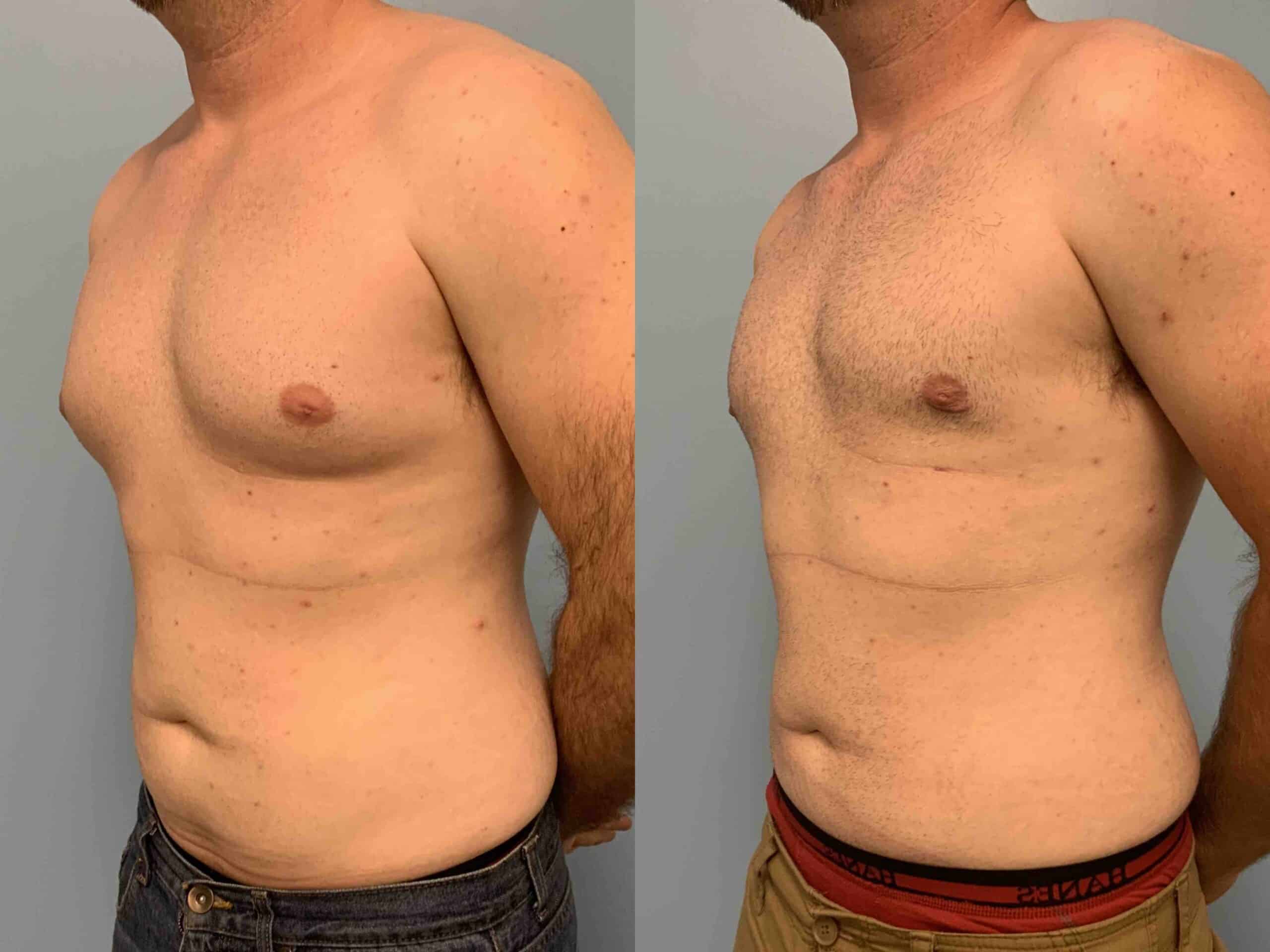 Before and after, patient 6 mo post op from VASER Abdomen, Flank, Chest, Gynecomastia, procedures performed by Dr. Paul Vanek