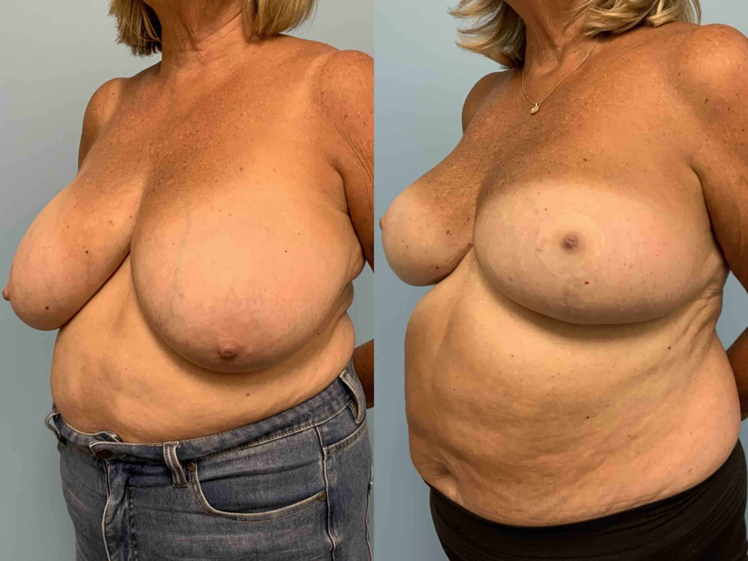 Before and after, patient 1 yr post op from Breast Reduction, VASER axilla, Axillary Roll Resection procedures performed by Dr. Paul Vanek