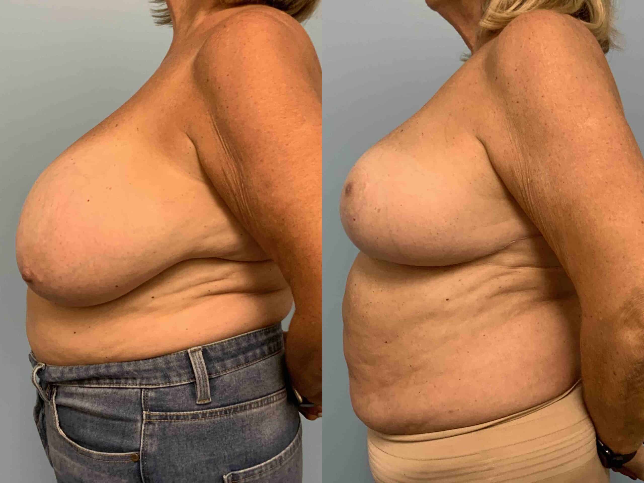 Before and after, patient 1 yr post op from Breast Reduction, VASER axilla, Axillary Roll Resection procedures performed by Dr. Paul Vanek