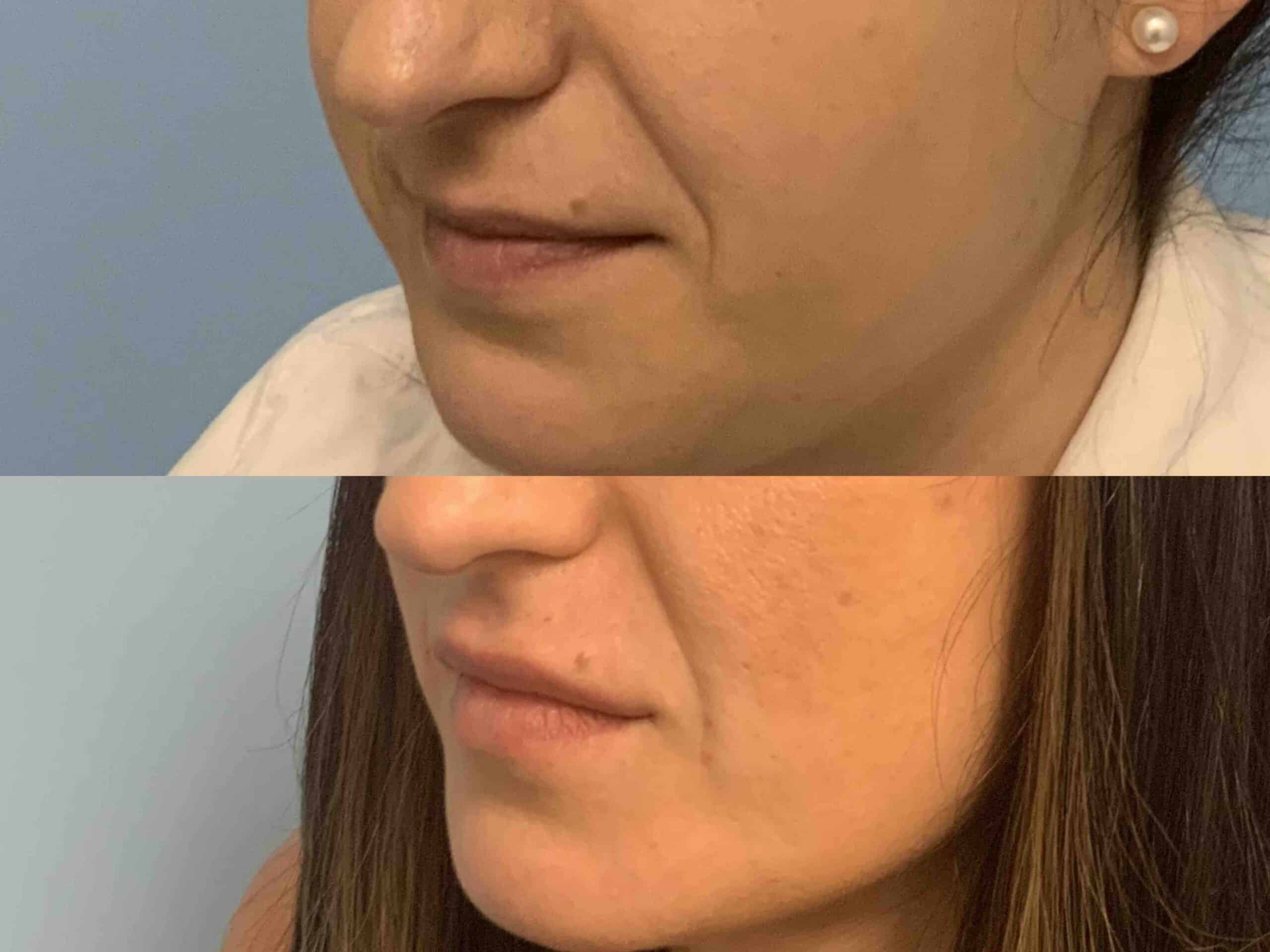 Before and after, patient post op from Lip Filler procedure performed by Dr. Paul Vanek