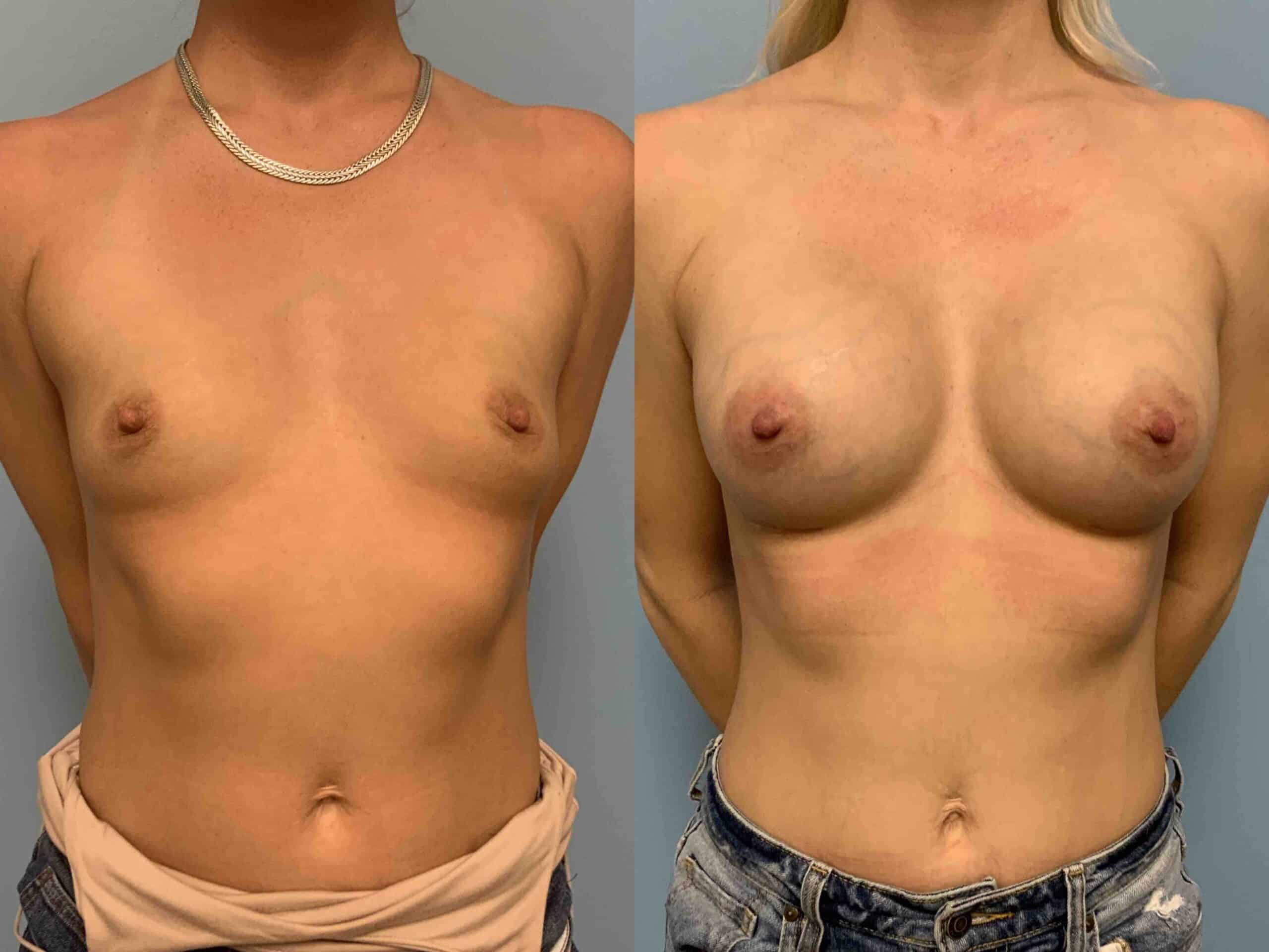 Before and after, patient 2 mo post op from Breast Augmentation, Level III Muscle Release, Strattice Inlay procedures performed by Dr. Paul Vanek