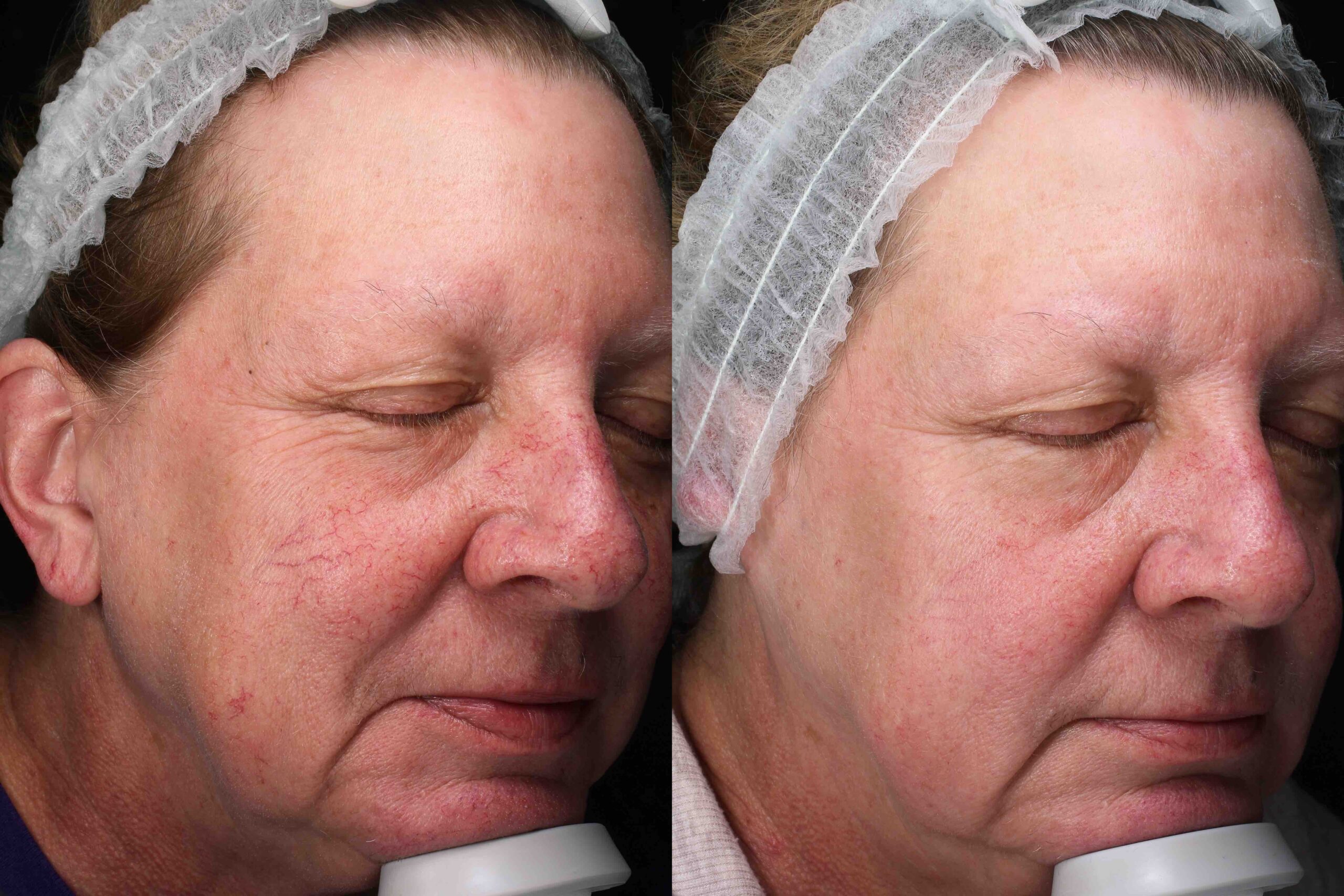 Before and after, 6 weeks post-treatment from Diolite 532 Laser, Forever Young performed by Dr. Paul Vanek (diagonal view, close up)