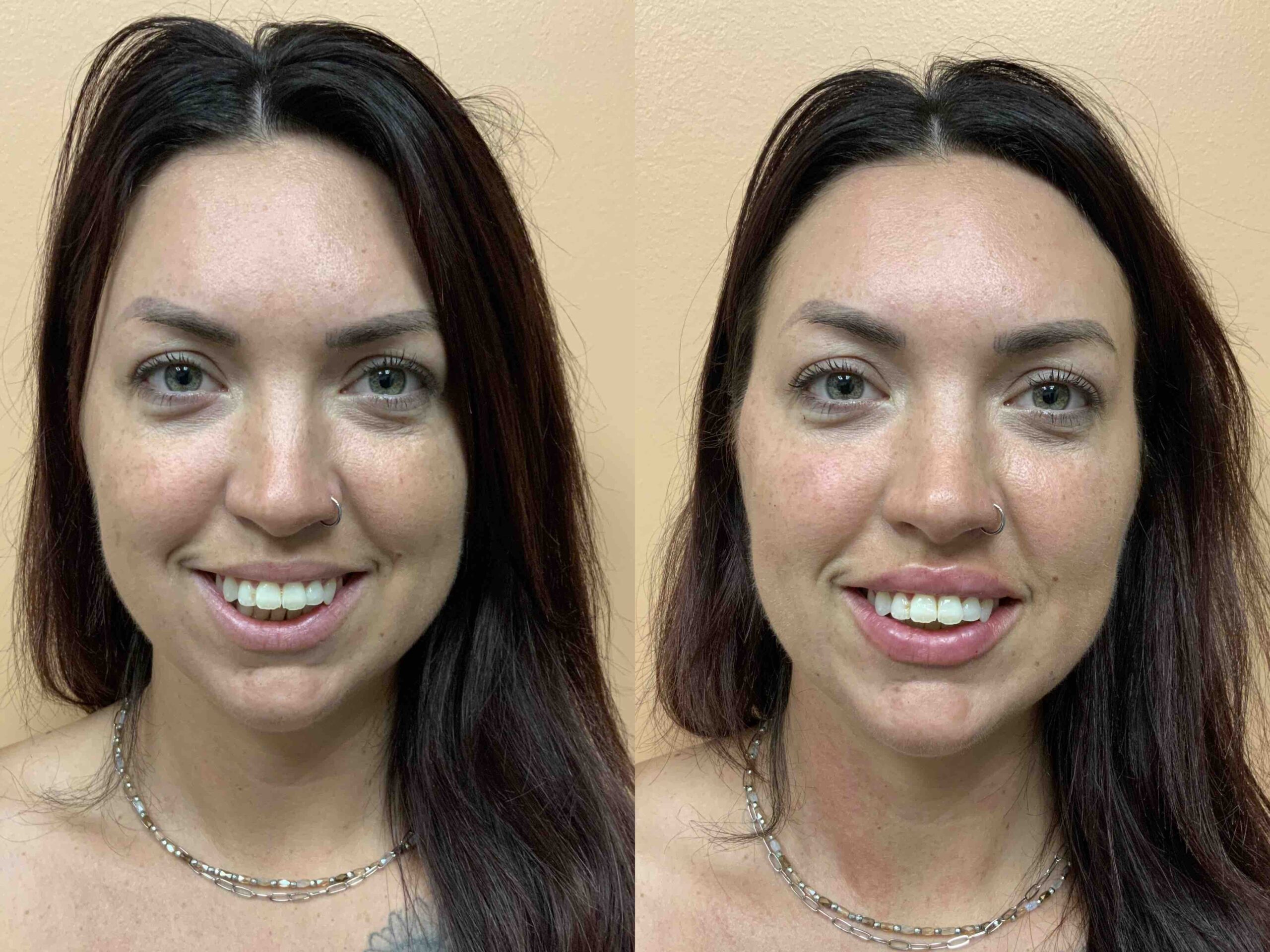 Before and after, patient same day after Fillers – Cheeks, Lips, and Jaw performed by Dr. Paul Vanek