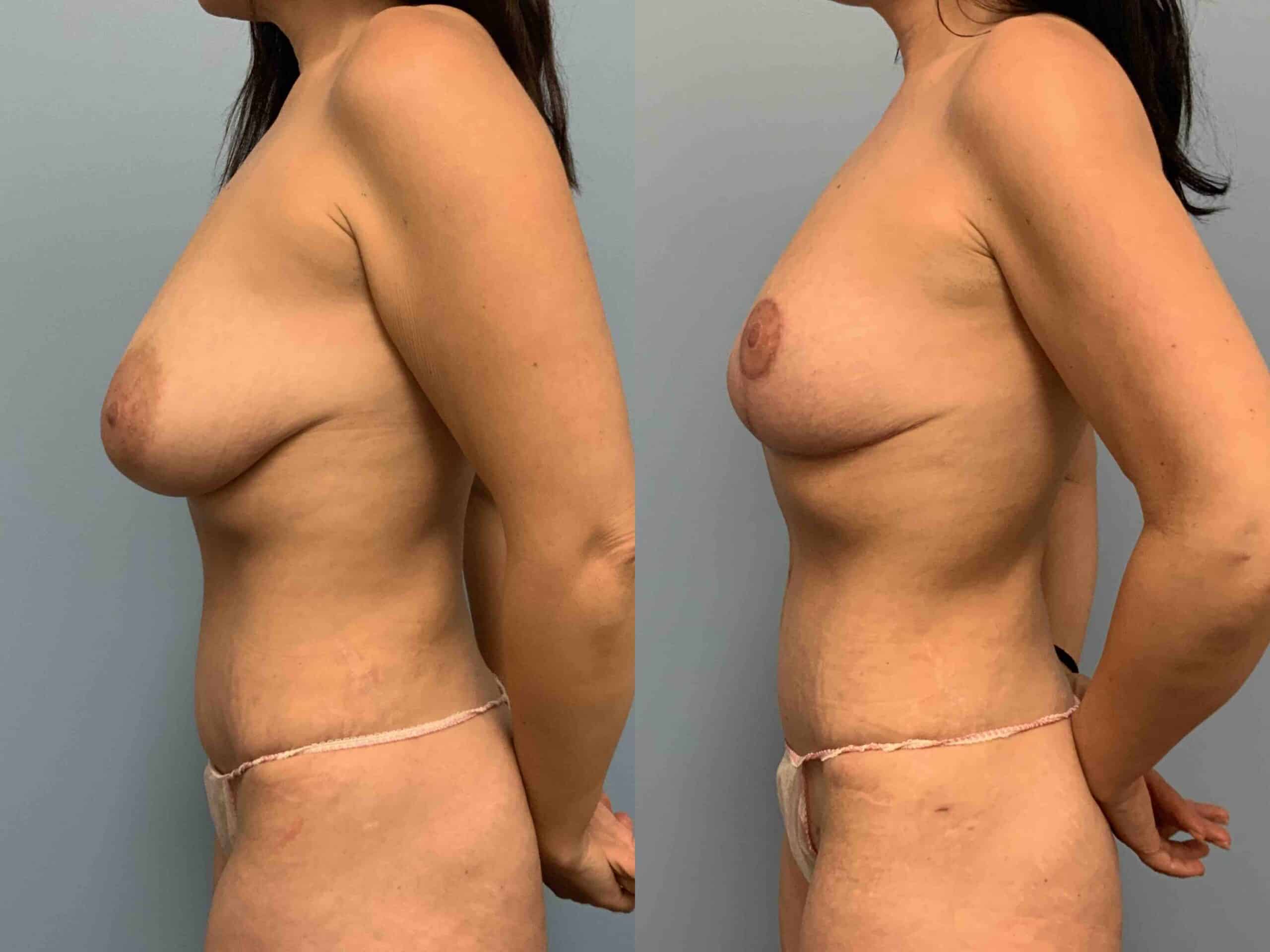 Before and after, patient 3 mo post op from Breast Reduction, VASER Abdomen and Flanks, Axillary Roll Reselection procedures performed by Dr. Paul Vanek