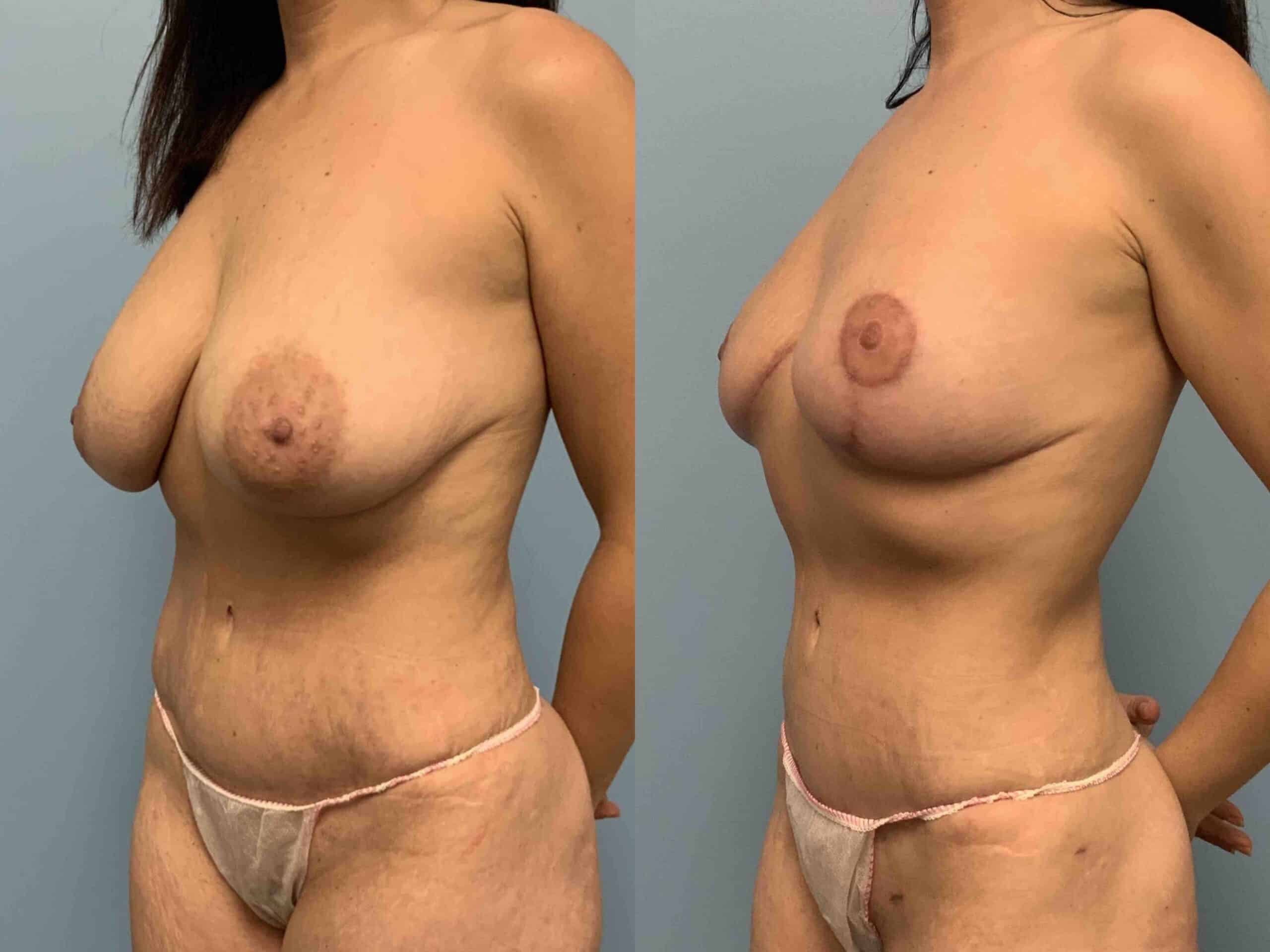 Before and after, patient 3 mo post op from Breast Reduction, VASER Abdomen and Flanks, Axillary Roll Reselection procedures performed by Dr. Paul Vanek