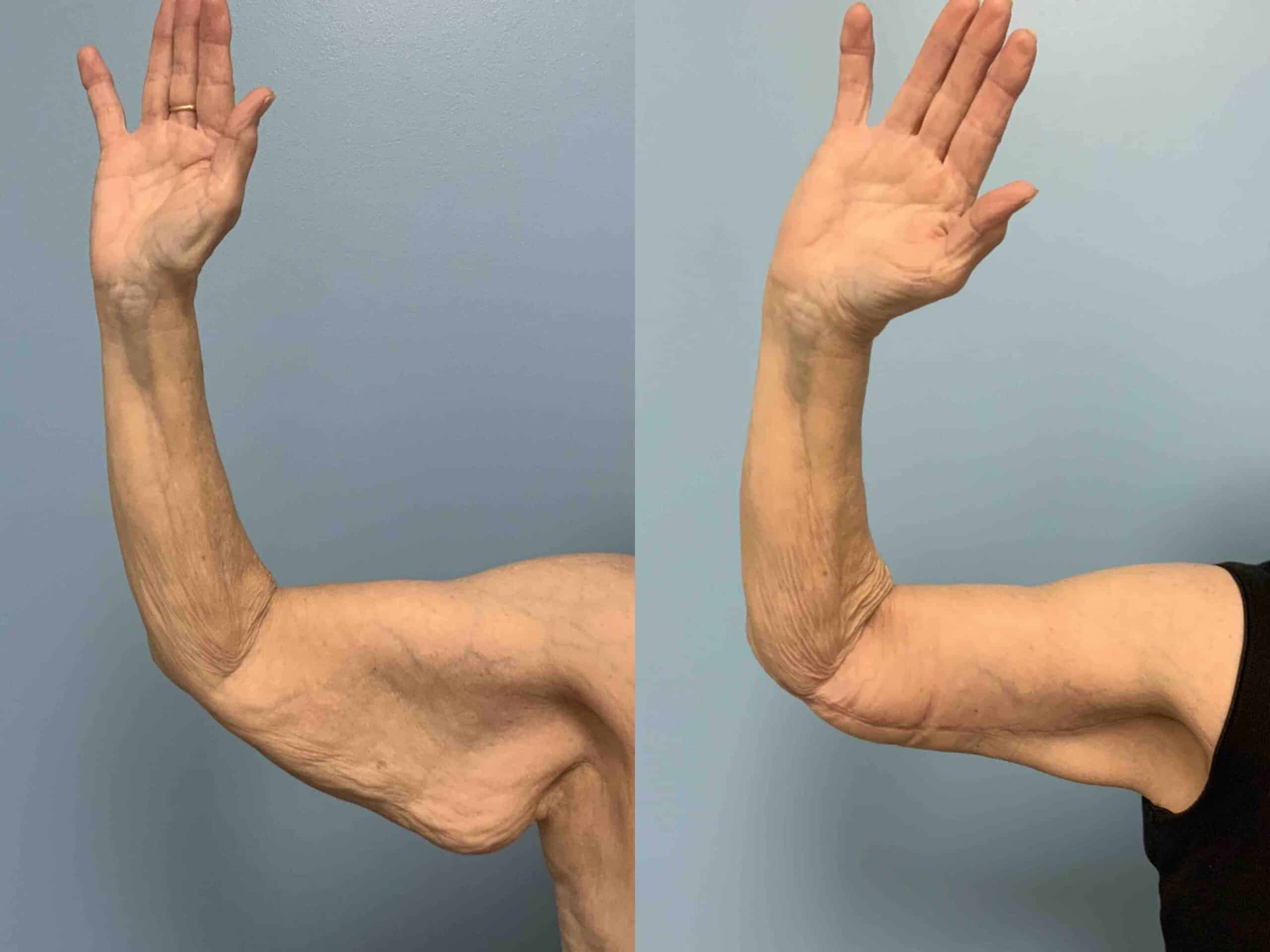 Before and after, patient 2 mo post op from Brachioplasty and VASER arms treatment performed by Dr. Paul Vanek