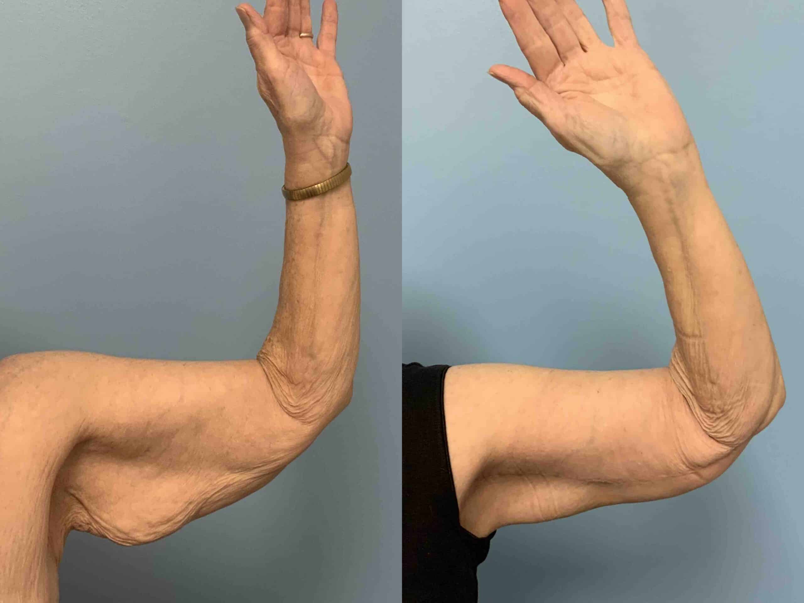 Before and after, patient 2 mo post op from Brachioplasty and VASER arms treatment performed by Dr. Paul Vanek