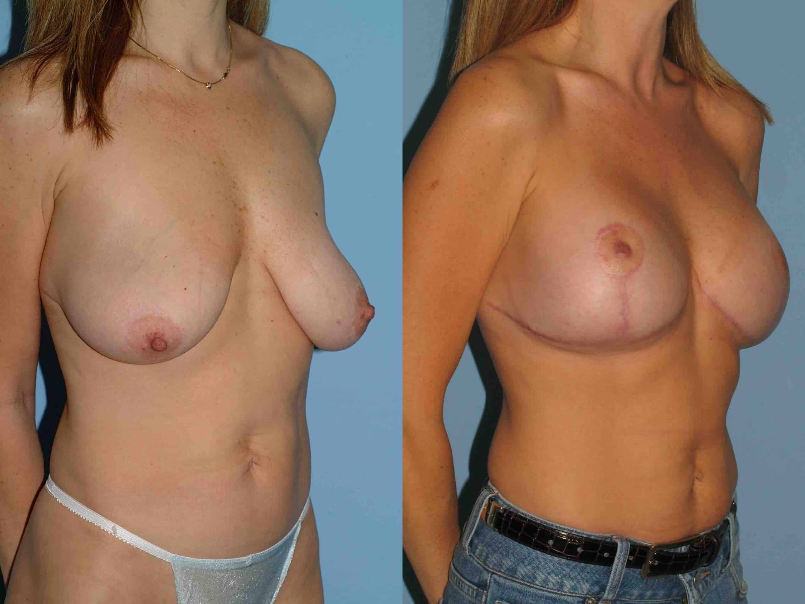 Before and after, patient 10 mo post op from Breast Augmentation, Mastopexy/Breast Lift procedures performed by Dr. Paul Vanek