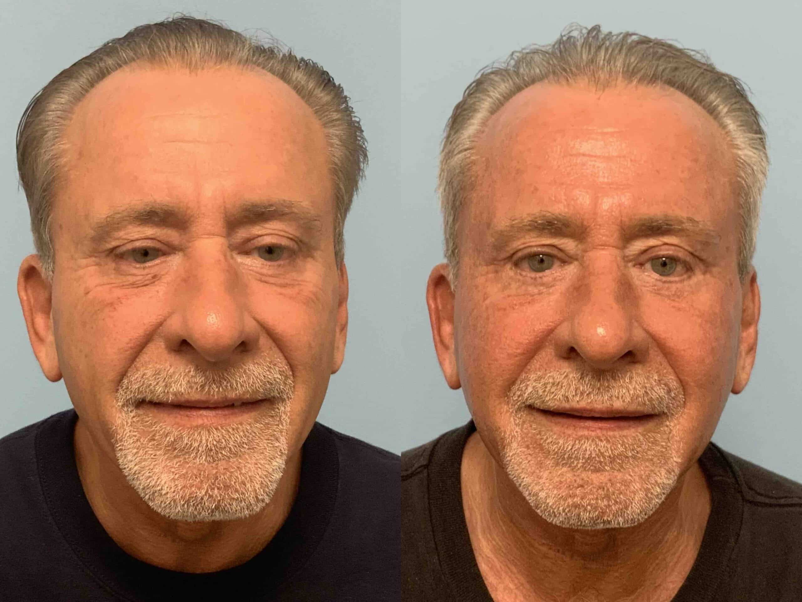 Before and after, 11 months post op from Lower Lid Blepharoplasty/Canthopexy, Sculptra Injectable, performed by Dr. Paul Vanek (front view)